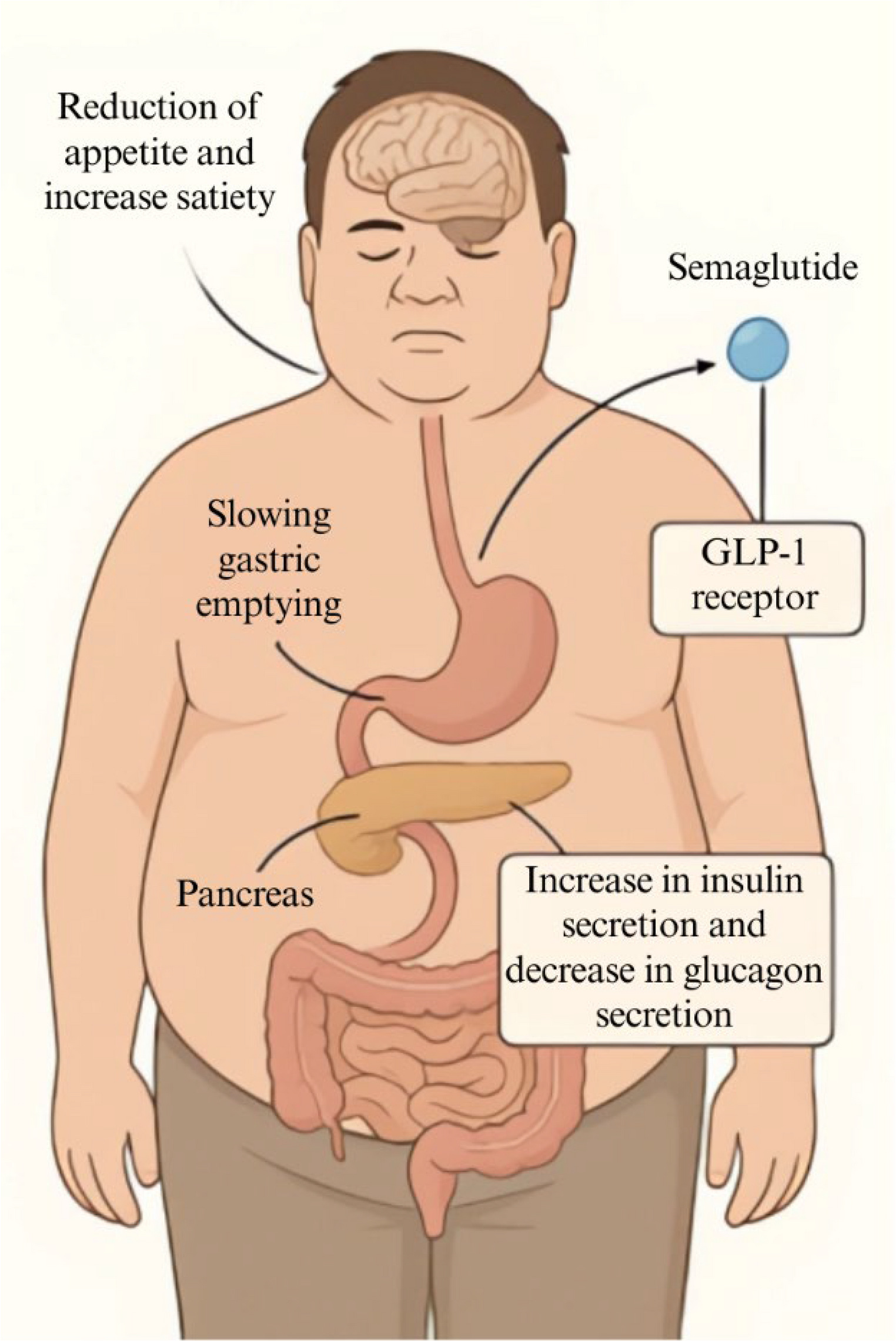 A Multidisciplinary Perspective on Semaglutide Treatment and Medical Nutrition Therapy in Obesity Management