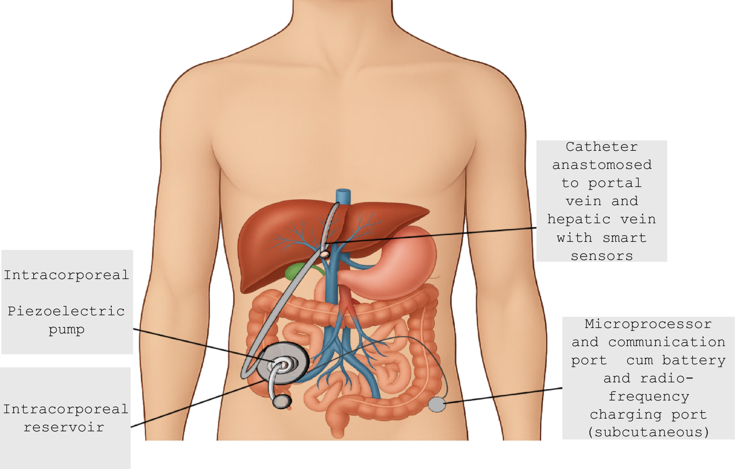 Recombinant albumin in cirrhosis: can this be a reality?