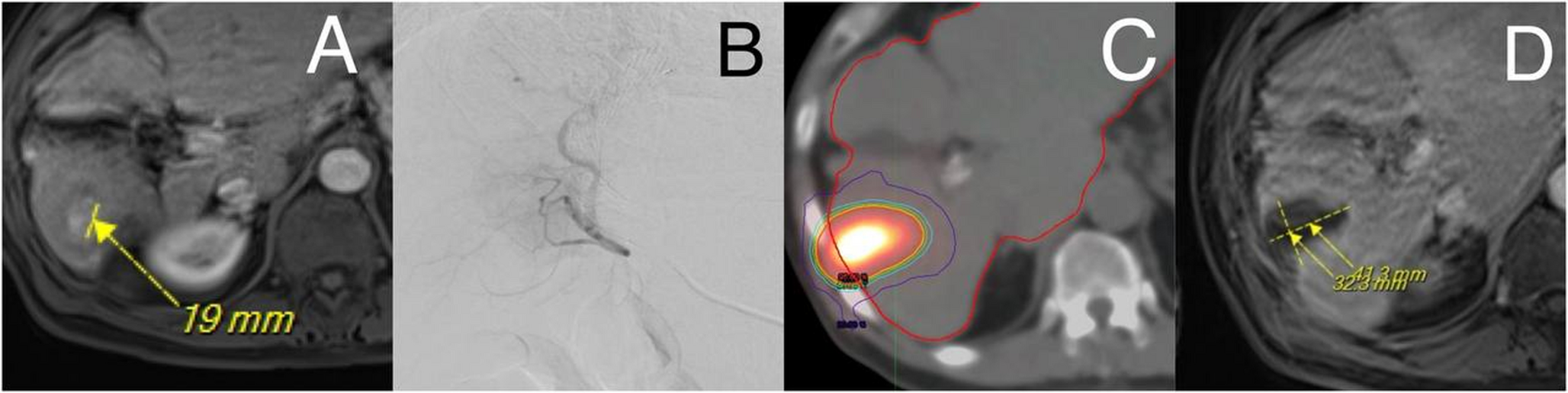 Radioembolization in Hepatocellular Carcinoma: Indications and Outcomes