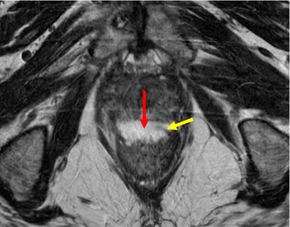 Hydrogel injection outside of prostate radiation: an overview