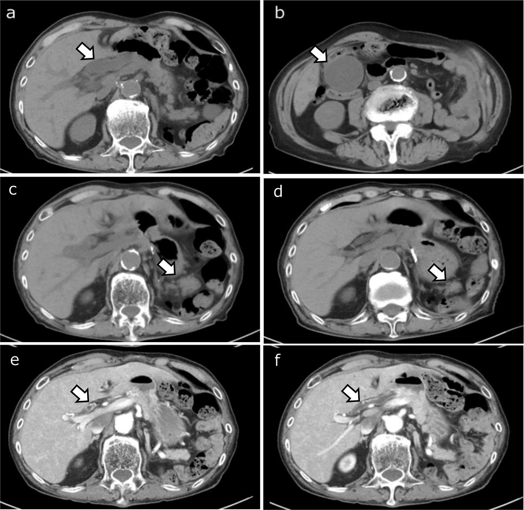 Case of simultaneous occurrence of hepatitis, cholangitis, and pancreatitis as immune-related adverse events induced by immune checkpoint inhibitor therapy: a case report