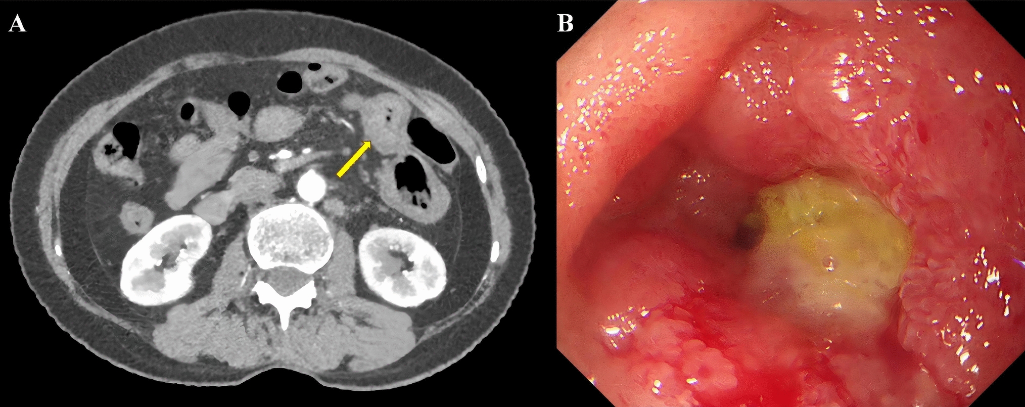 Cervical Cancer Metastasis Presenting as Small Bowel Stricture