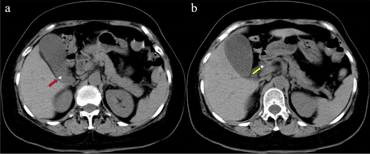 Successful Removal of Gallbladder and Common Bile Duct Stone in a Single Session Using a Single-Operator Cholangioscopy
