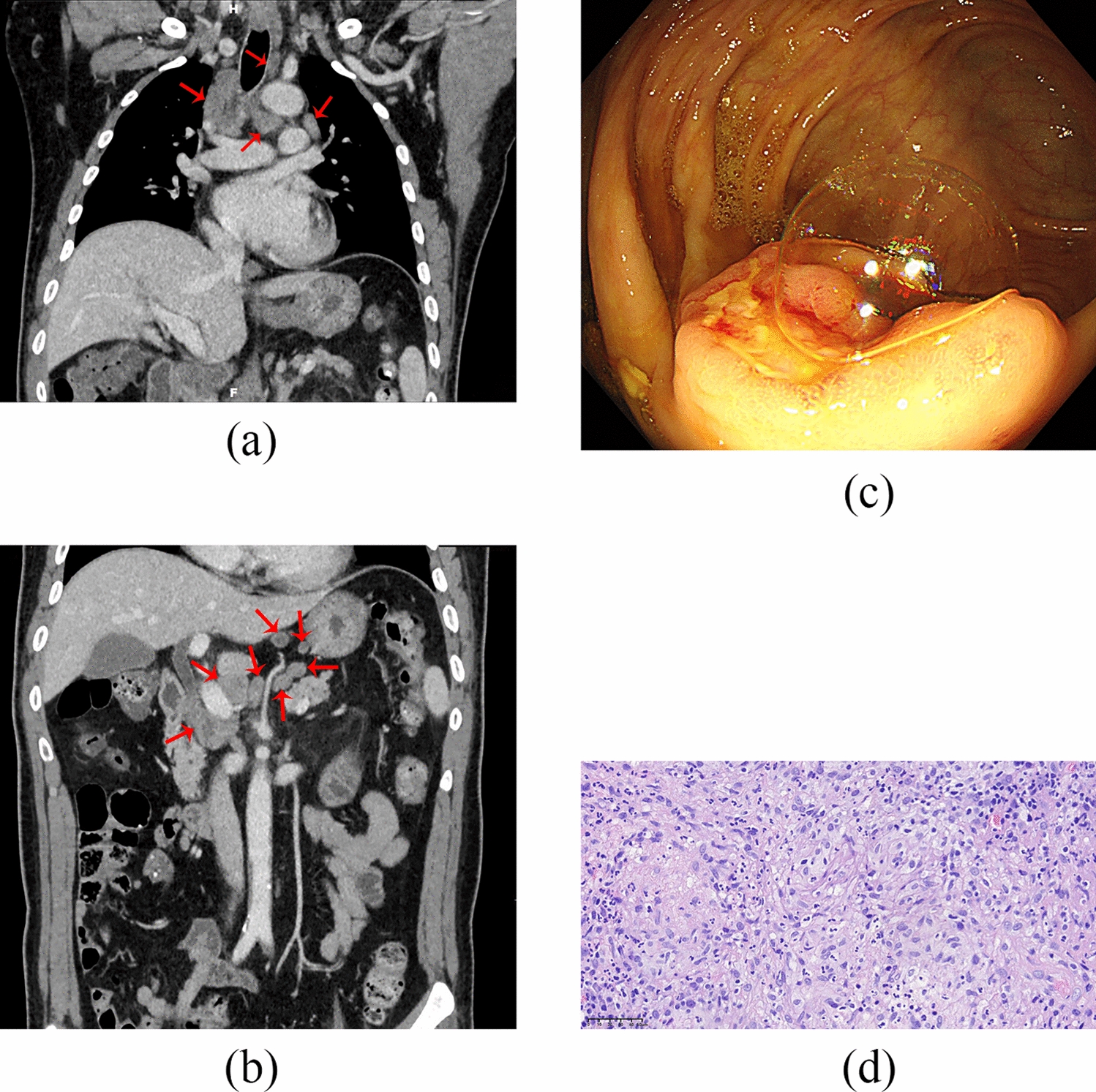 A Case of False-Negative Staining Findings of Intestinal Tuberculosis and Multiple Lymphadenopathy