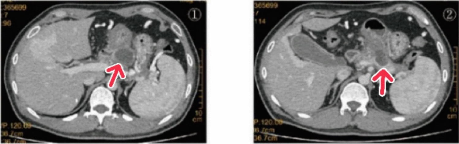 Massive Upper Gastrointestinal Bleeding Due to Rupture of a Pancreatic Pseudocyst into the Duodenum