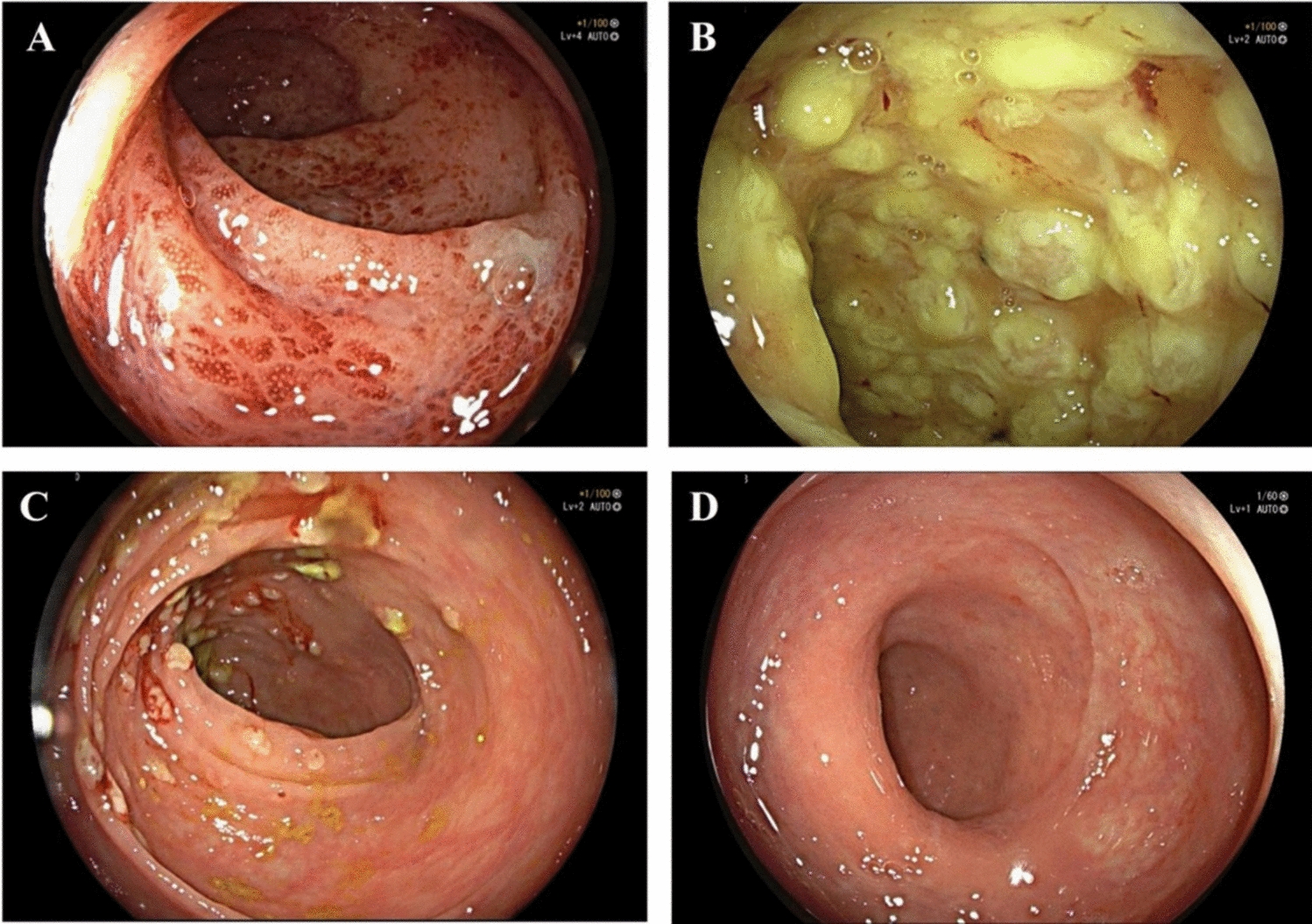 Walking on a Tightrope: Ulcerative Colitis Complicated by  Infection