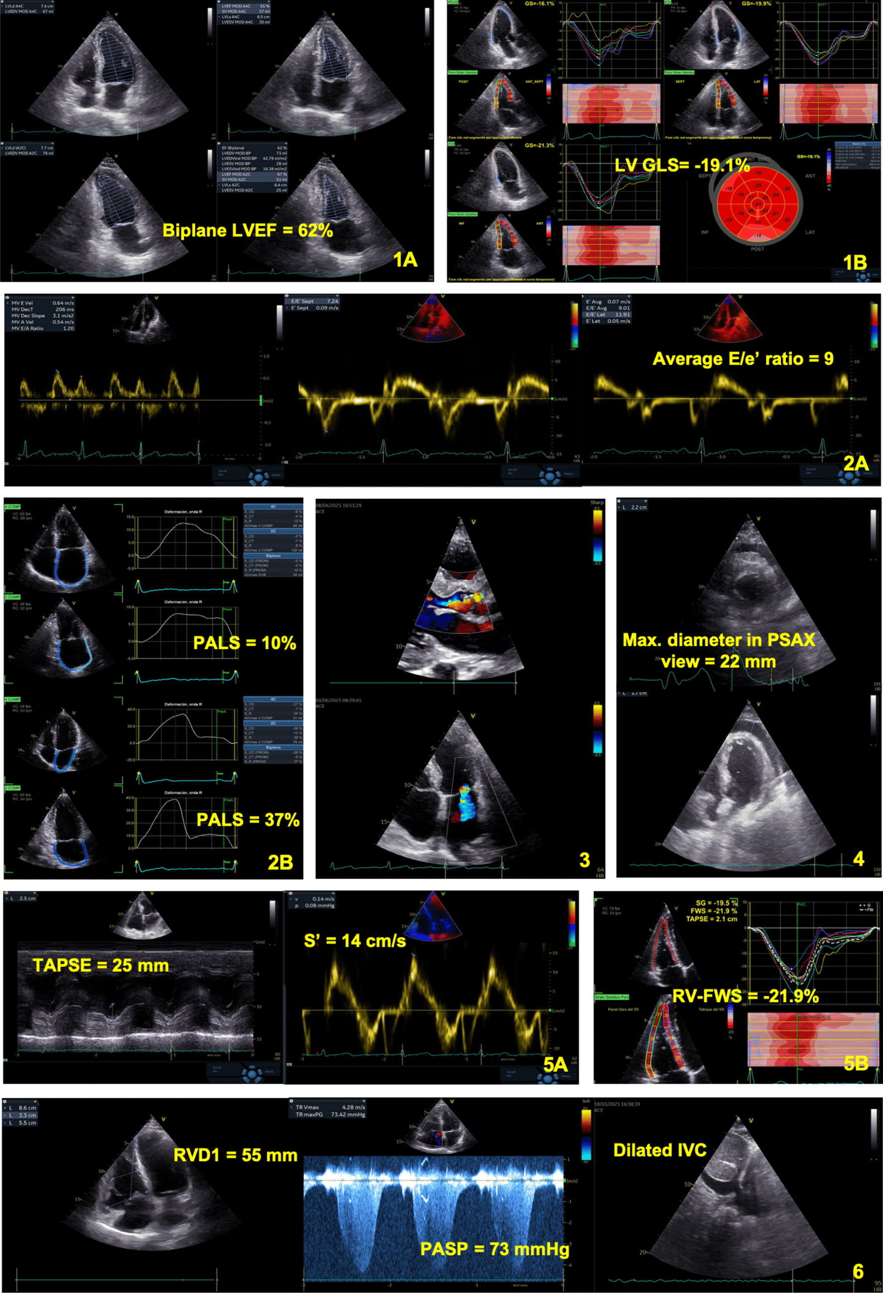 Echocardiographic monitoring in cancer therapy: clinical guidance for cardiologists and oncologists