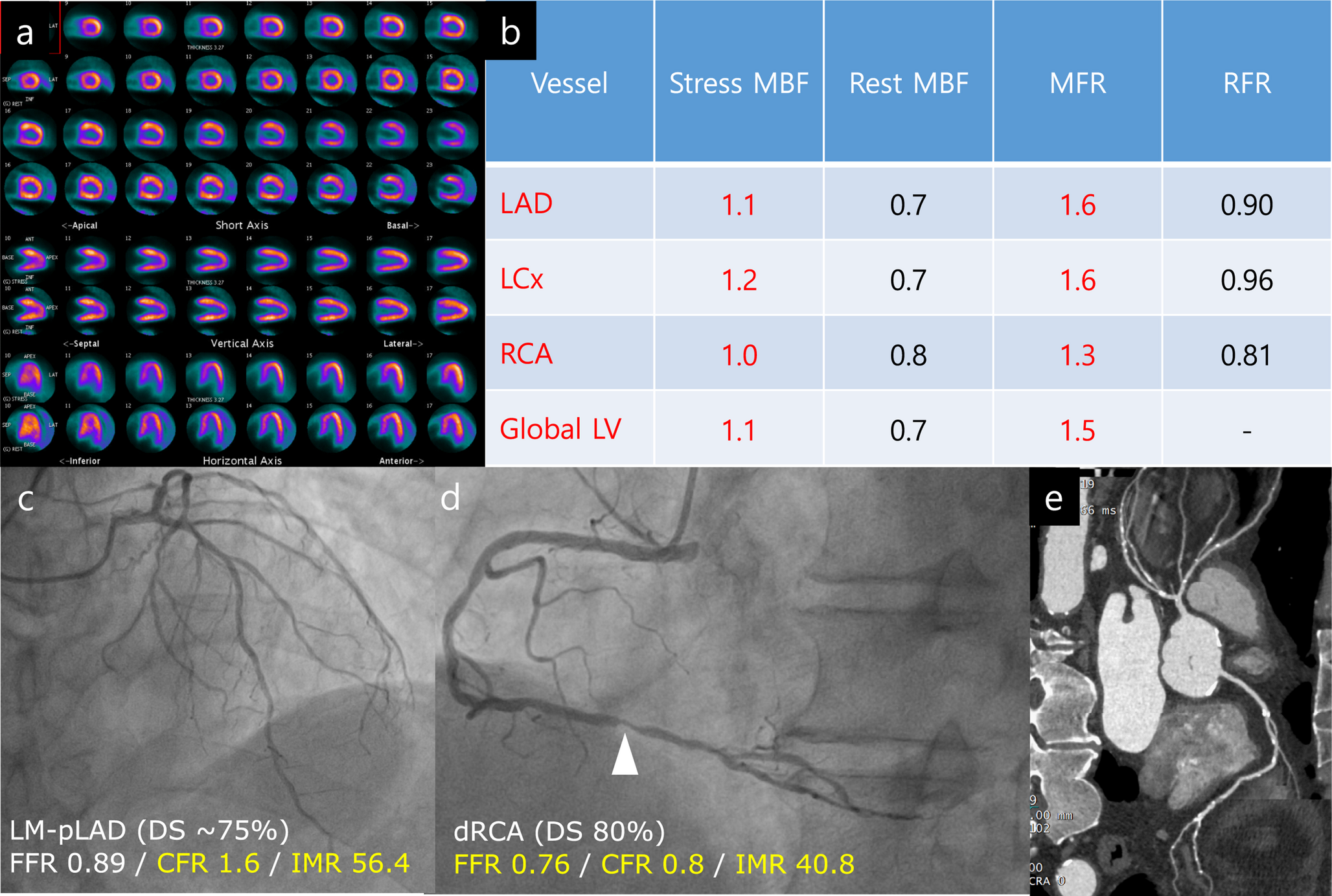 Nuclear Cardiology Post-ISCHEMIA