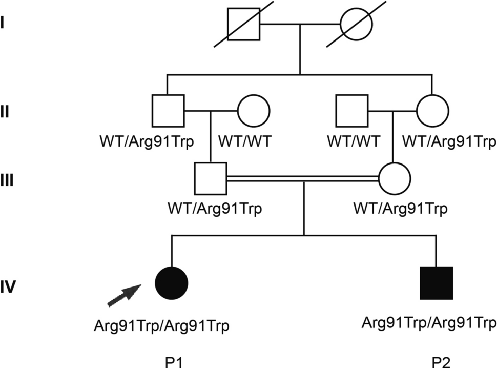 Deficiency of  causes Parkinson’s disease due to loss of dopamine neurons