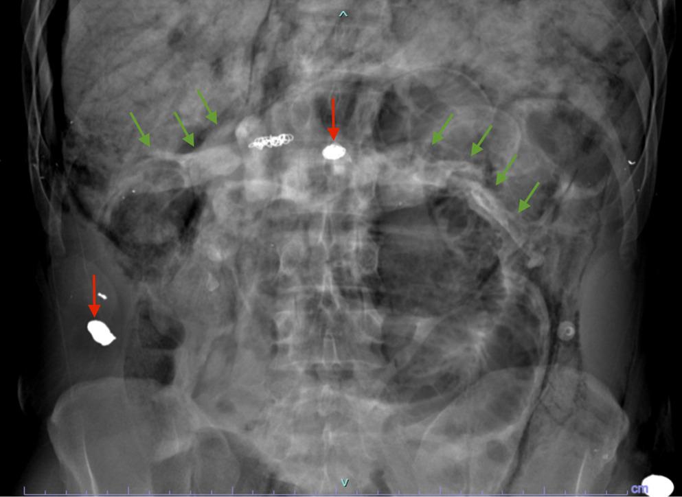 A rare case of heterotopic mesenteric ossification after remote abdominal gunshot wounds