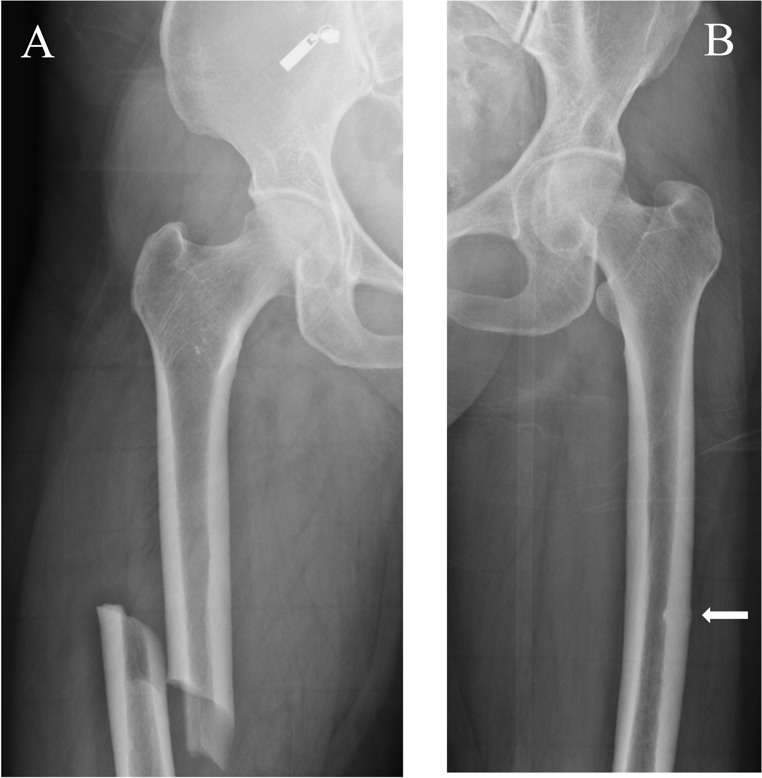 Epidemiology, Pathophysiology and Management of Atypical Femur Fractures: an Update