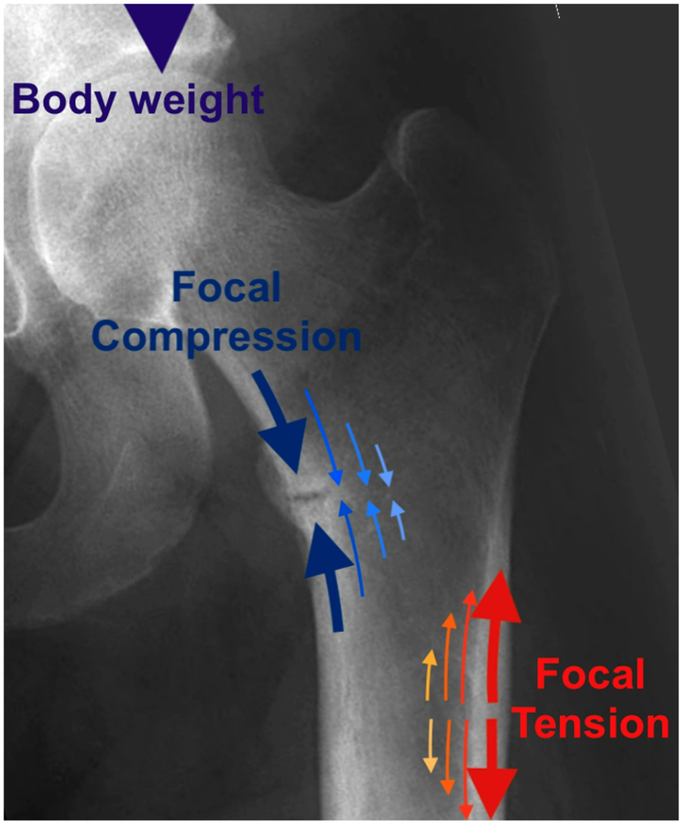 Pathophysiology of Femoral Fractures in Hypophosphatasia