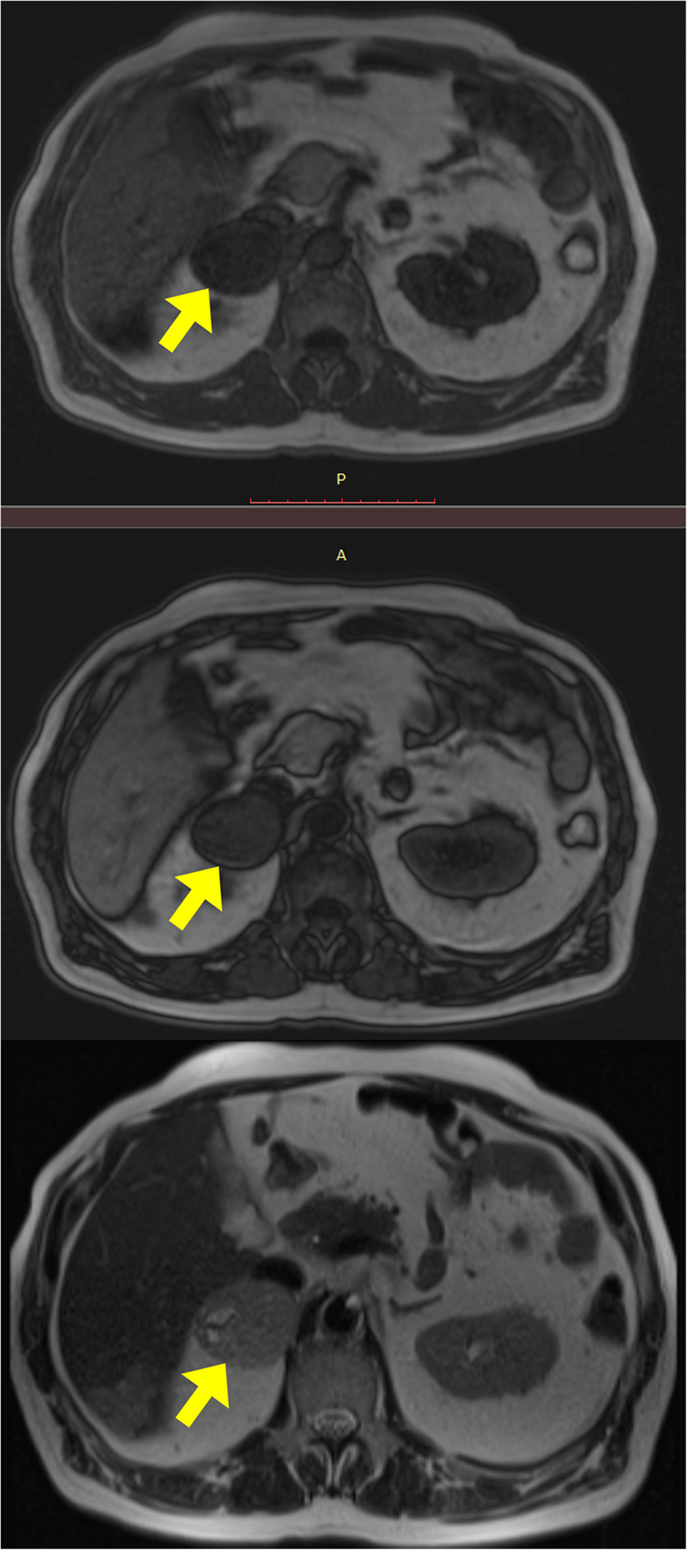 Presentation of a missense  variant in a Greek patient with pheochromocytoma