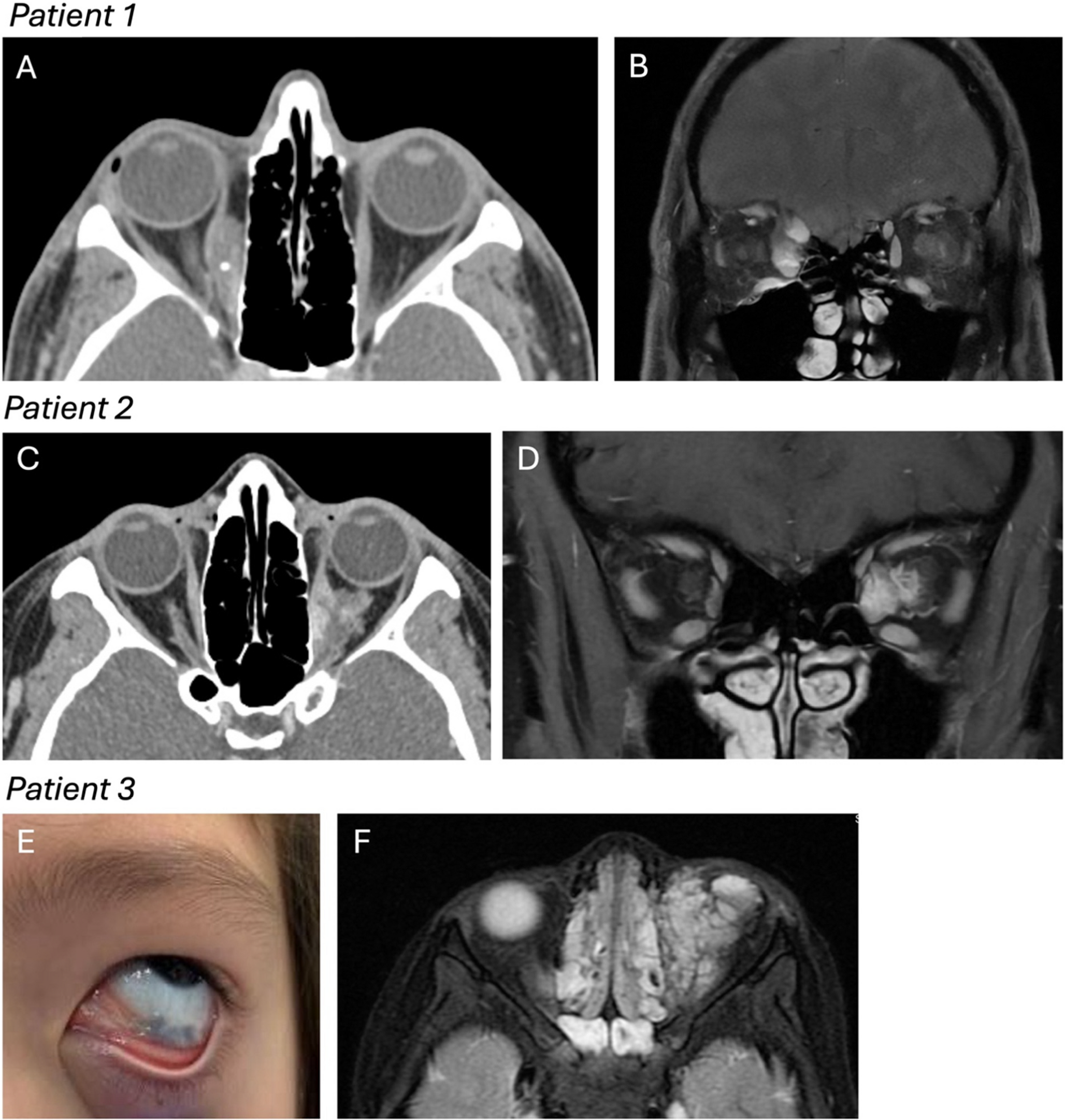 Update on Treatment of Orbital Venous-Lymphatic Malformations