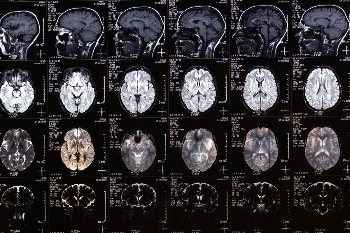 Neurological and Psychiatric Manifestations of Cerebral Arteriovenous Malformation: A Case of Hemichorea and Depression