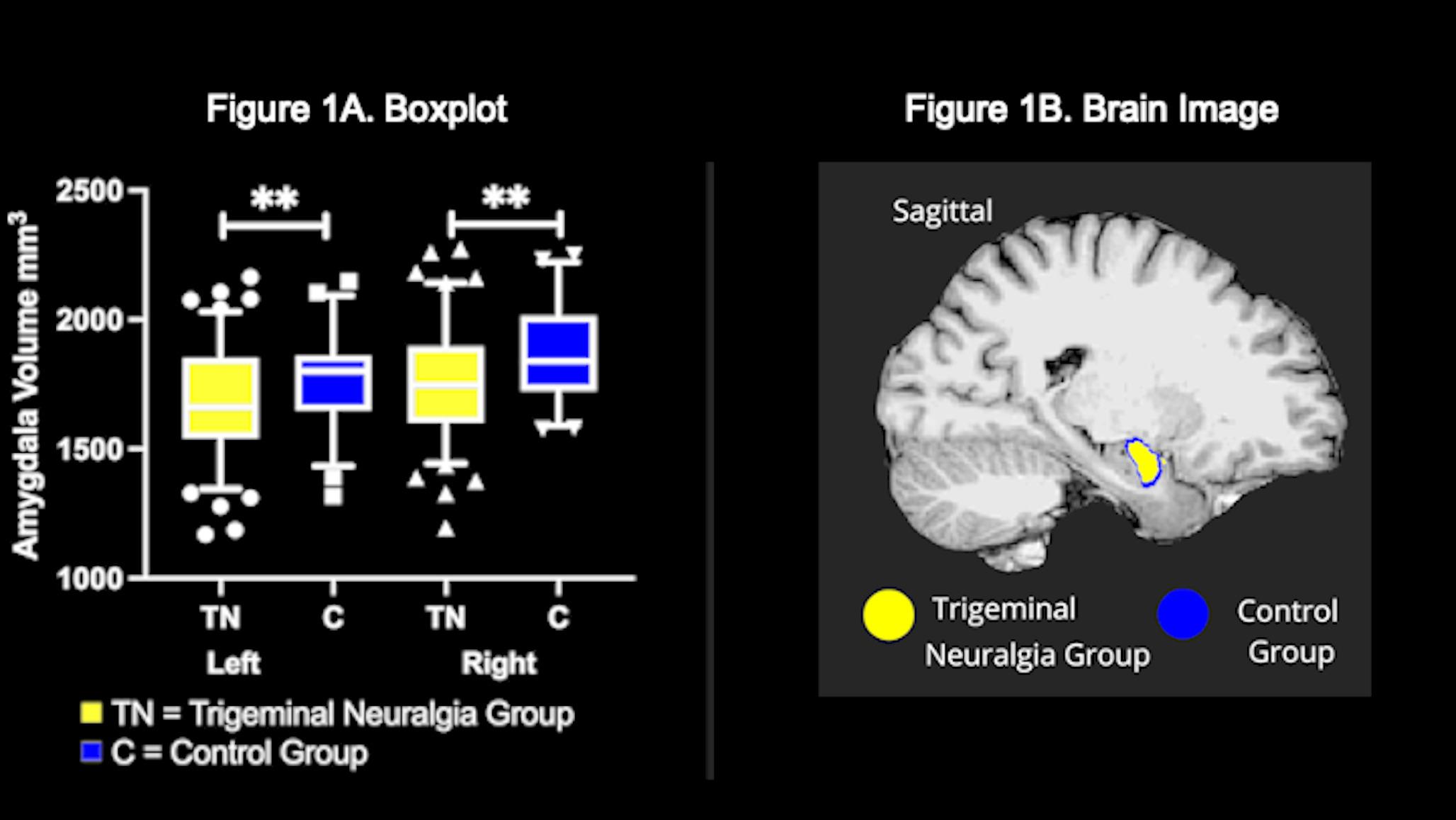Reduced volume in the amygdala of trigeminal neuralgia patients: a neuroimaging study with clinical correlates