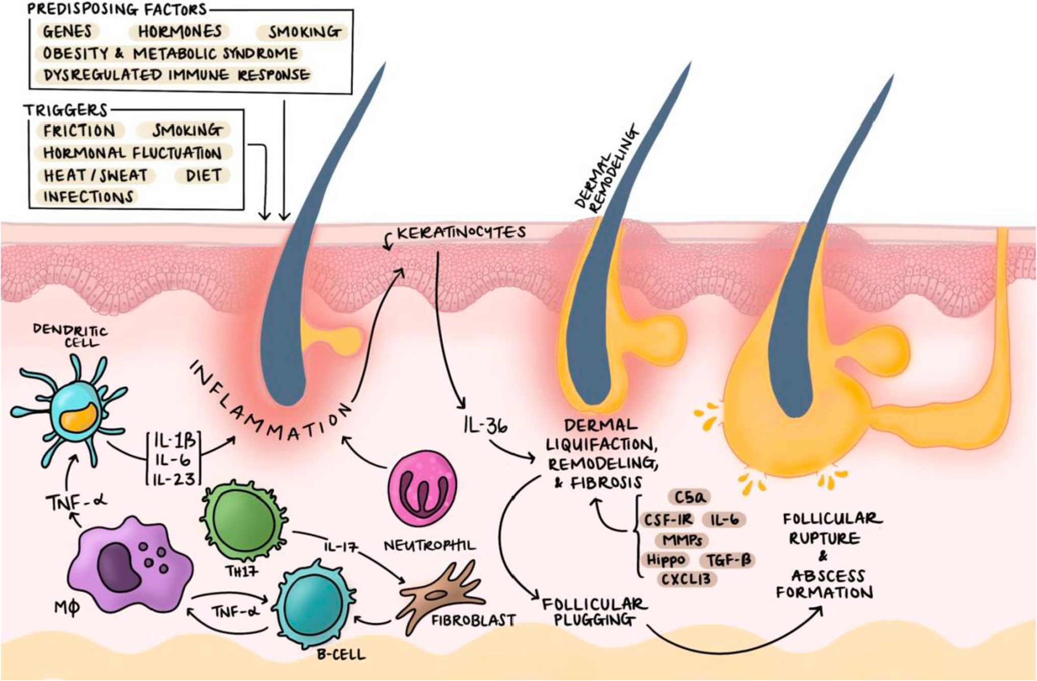 Update on Hidradenitis Suppurativa Management for the Inpatient Dermatologist