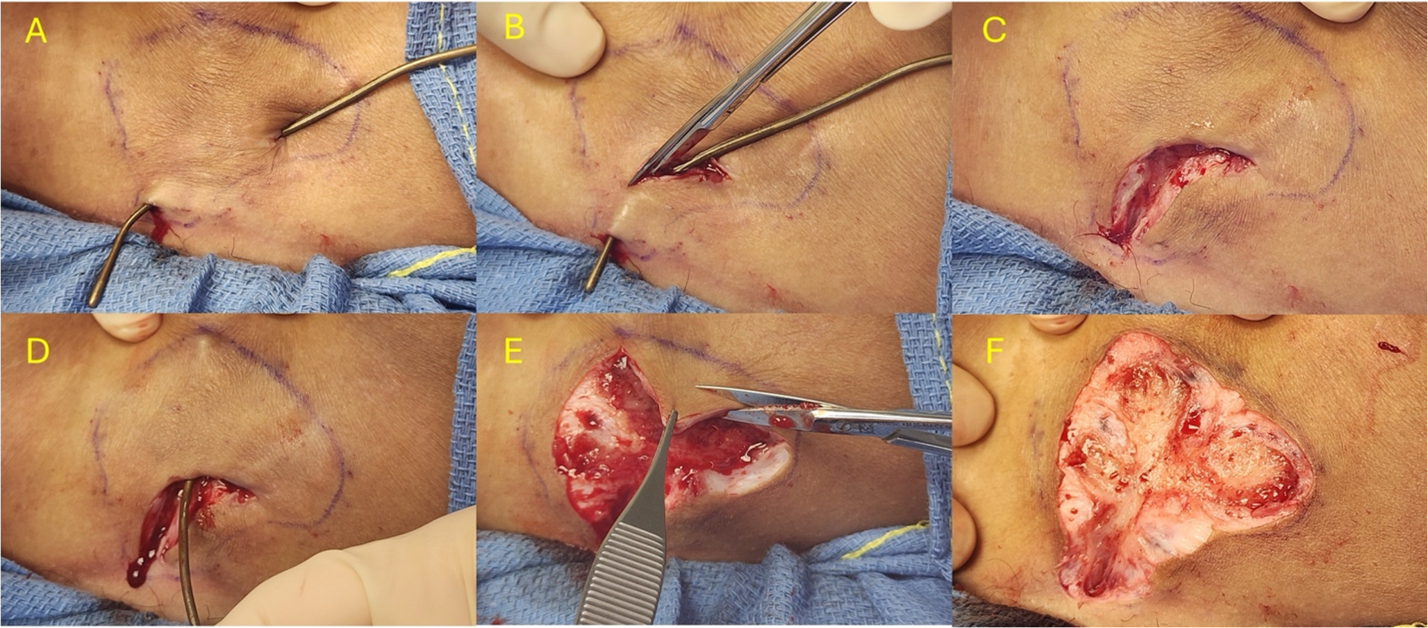 Procedural Interventions for Hidradenitis Suppurativa: A Narrative Review