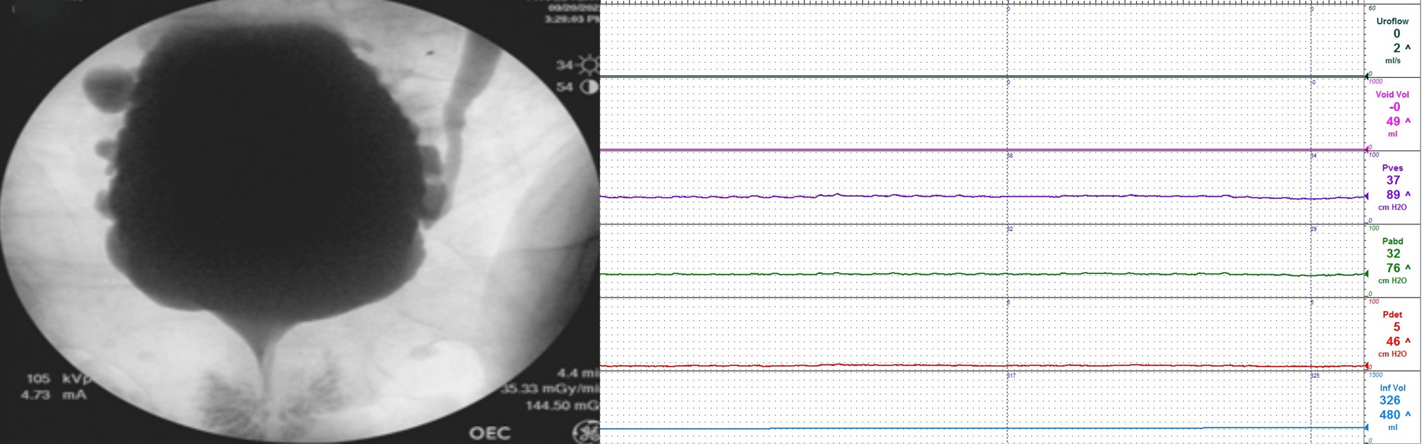 When is Video Urodynamics (VUDS) Preferred Over Conventional Urodynamics (CUDS) in the Evaluation of Neurogenic Lower Urinary Tract Dysfunction (NLUTD)?