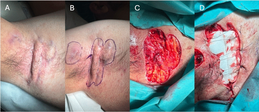 Defining Surgical Recurrence Patterns in Hidradenitis Suppurativa: Insights from 206 Procedures and Literature Review
