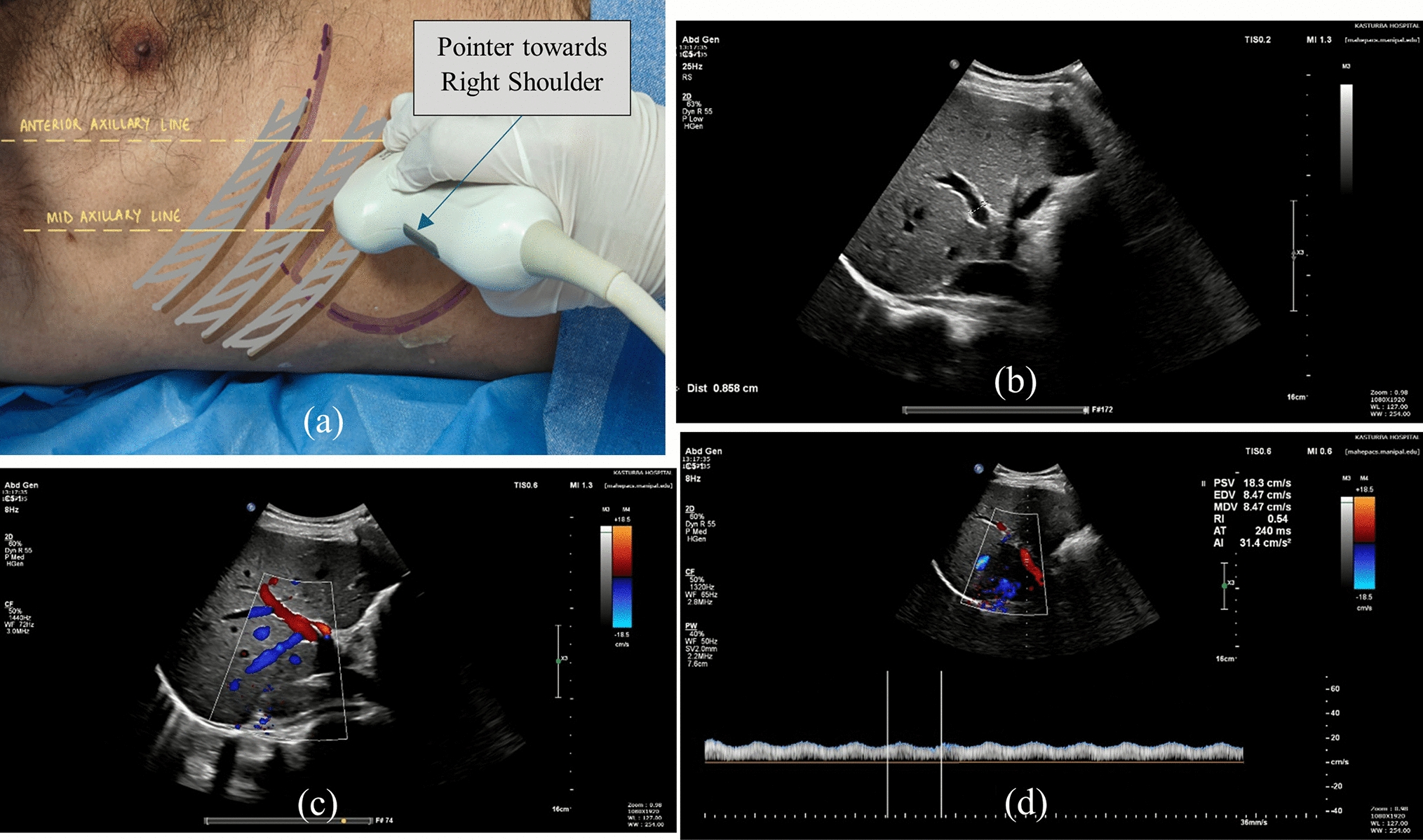 A portal into hemodynamics: utility of portal vein ultrasound in predicting variceal etiology of upper gastrointestinal hemorrhage in the emergency department
