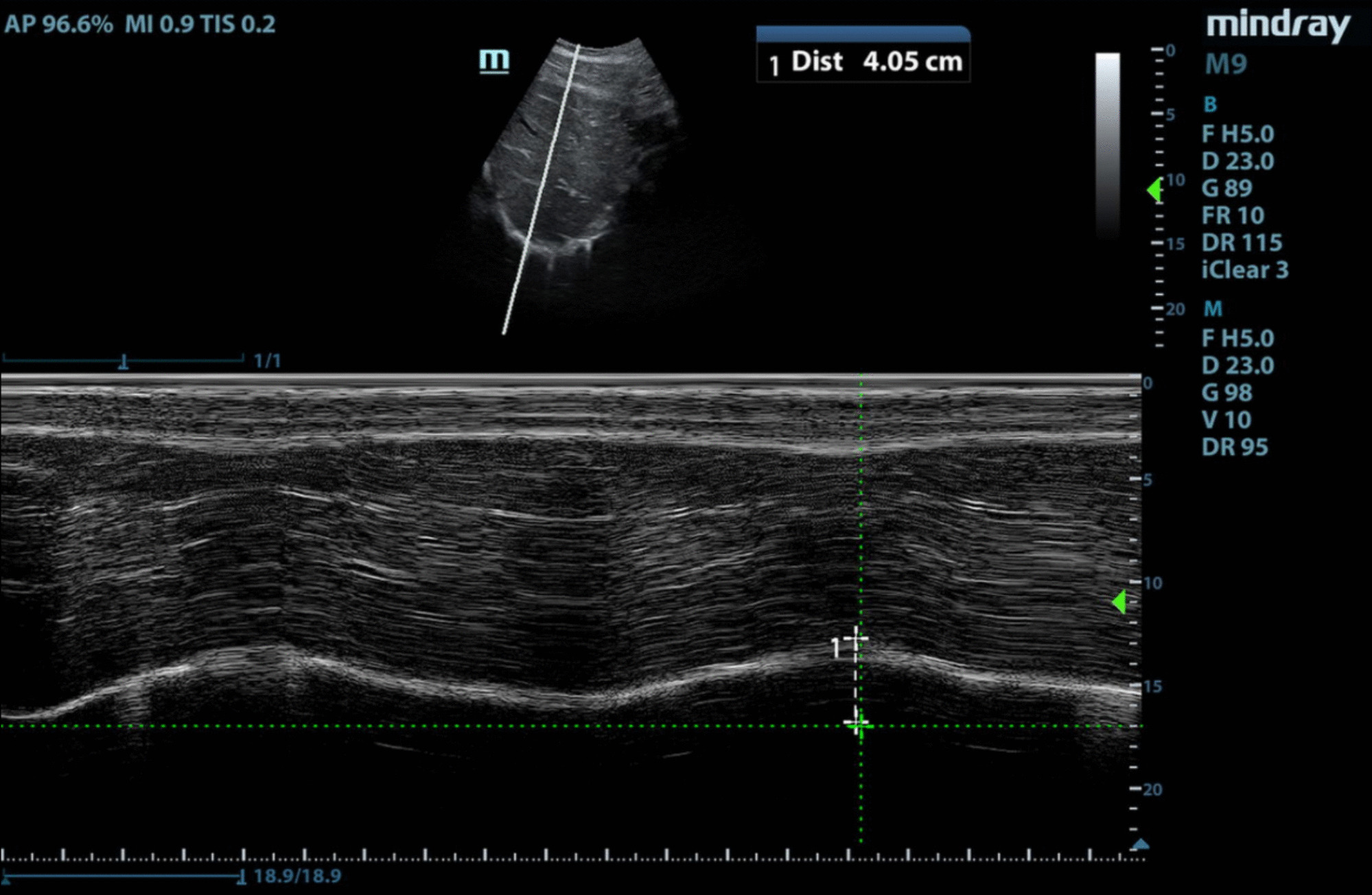 Diaphragm Ultrasound for Assessing Diaphragmatic Function and Predicting Ventilator Weaning Success: A Review of the Literature