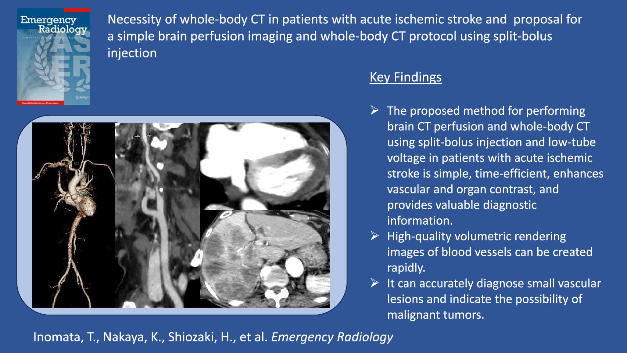 Necessity of whole-body CT in patients with acute ischemic stroke and proposal for a simple brain perfusion imaging and whole-body CT protocol using split-bolus injection