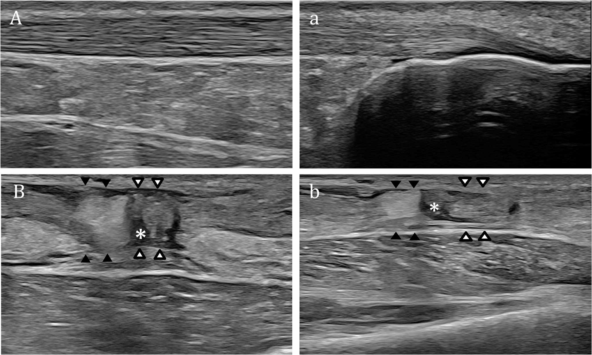 Musculoskeletal ultrasound in the emergency department: a narrative review for general radiologists