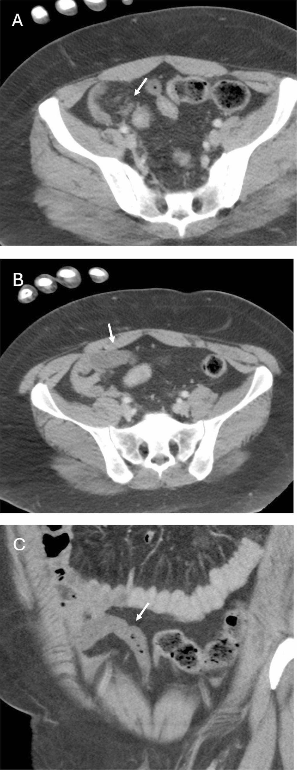 Discrepancies between community interpretations and emergency radiology re-interpretation of imaging exams on trauma patients transferred to a level 1 trauma center