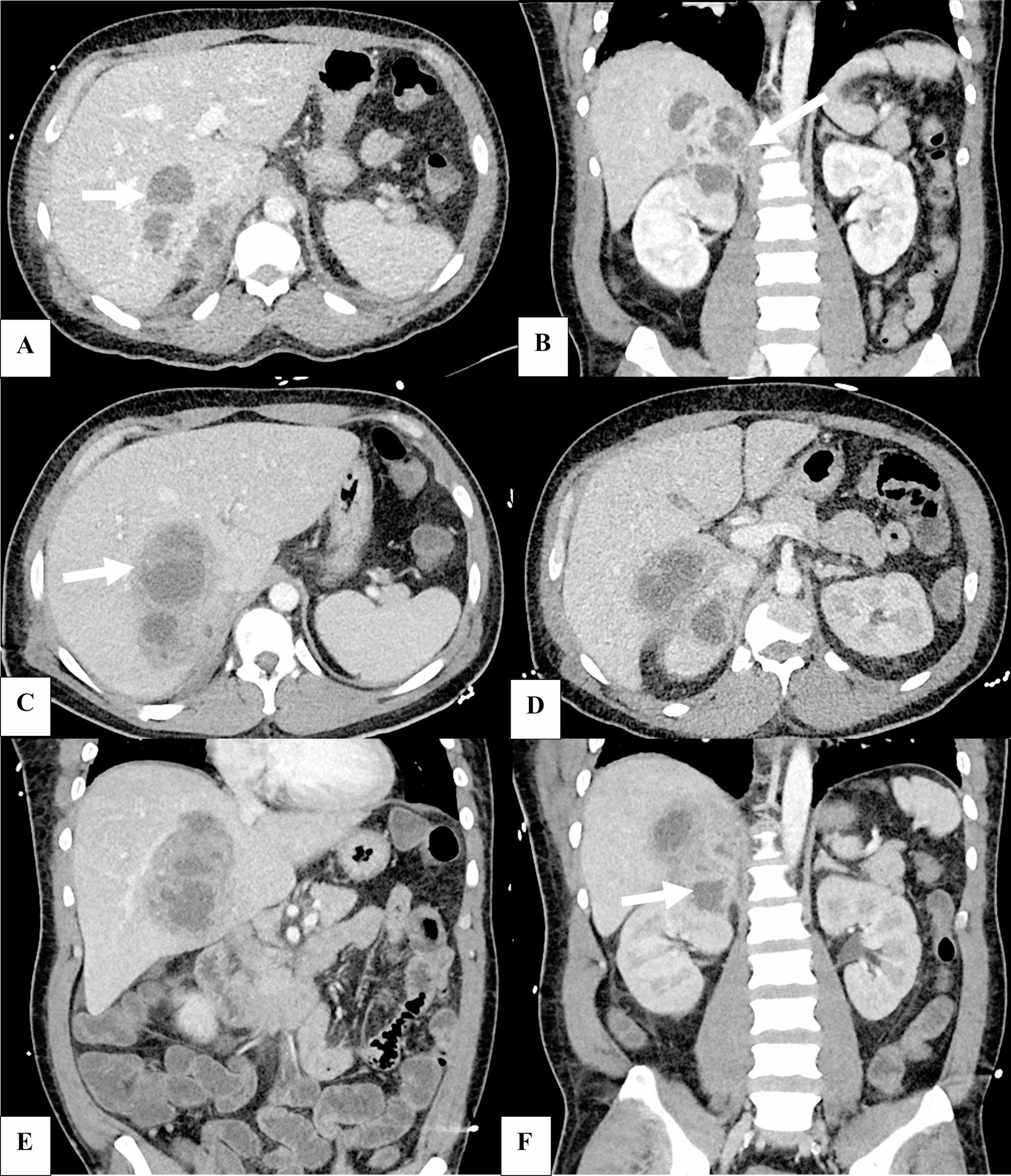 Adrenal abscesses: an uncommon and unexpected cause of the acute abdomen