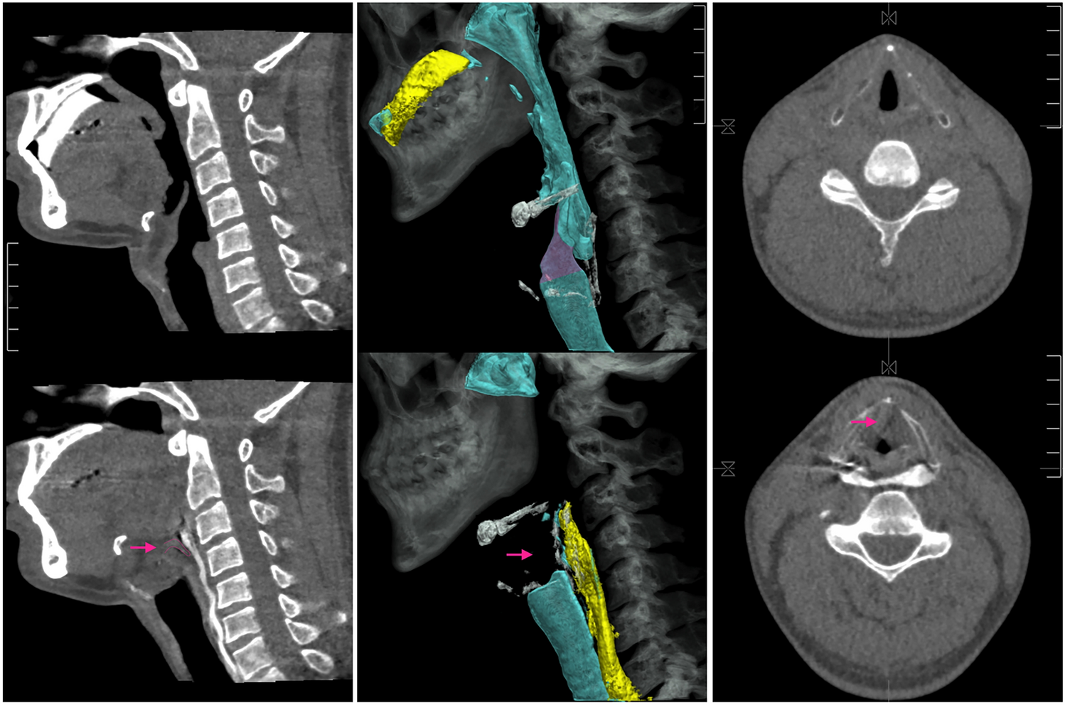 The Effect of Bolus Viscosity and Dysphagia Severity on Laryngeal Closure During Swallowing in Patients with Post-Stroke Dysphagia: A Kinematic Analysis Using Swallowing CT