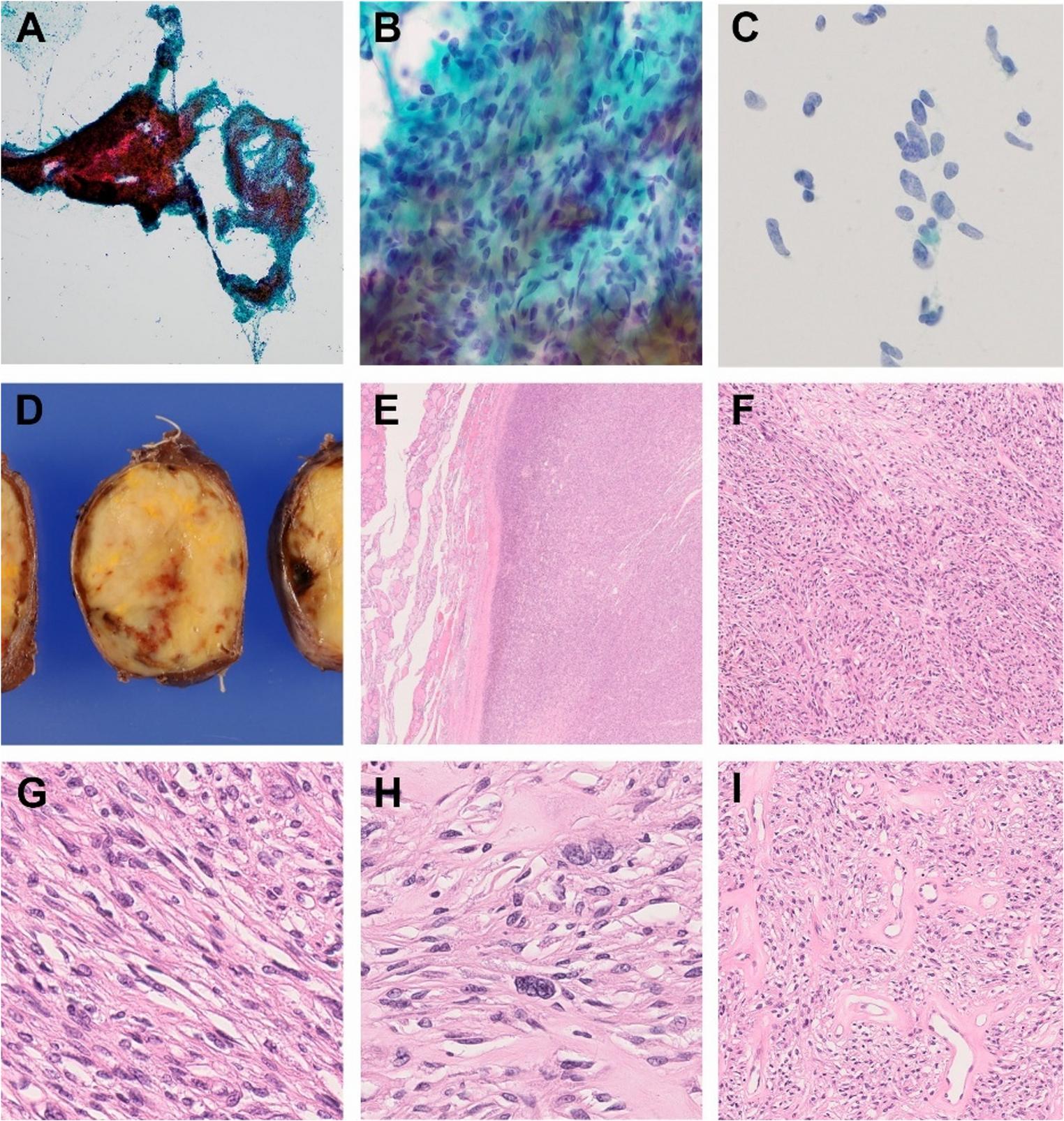 Non-Invasive Follicular Cell-Derived Thyroid Neoplasm Composed Entirely of Spindle Cells Harboring  p.Q61R Mutation and Variable Atypia