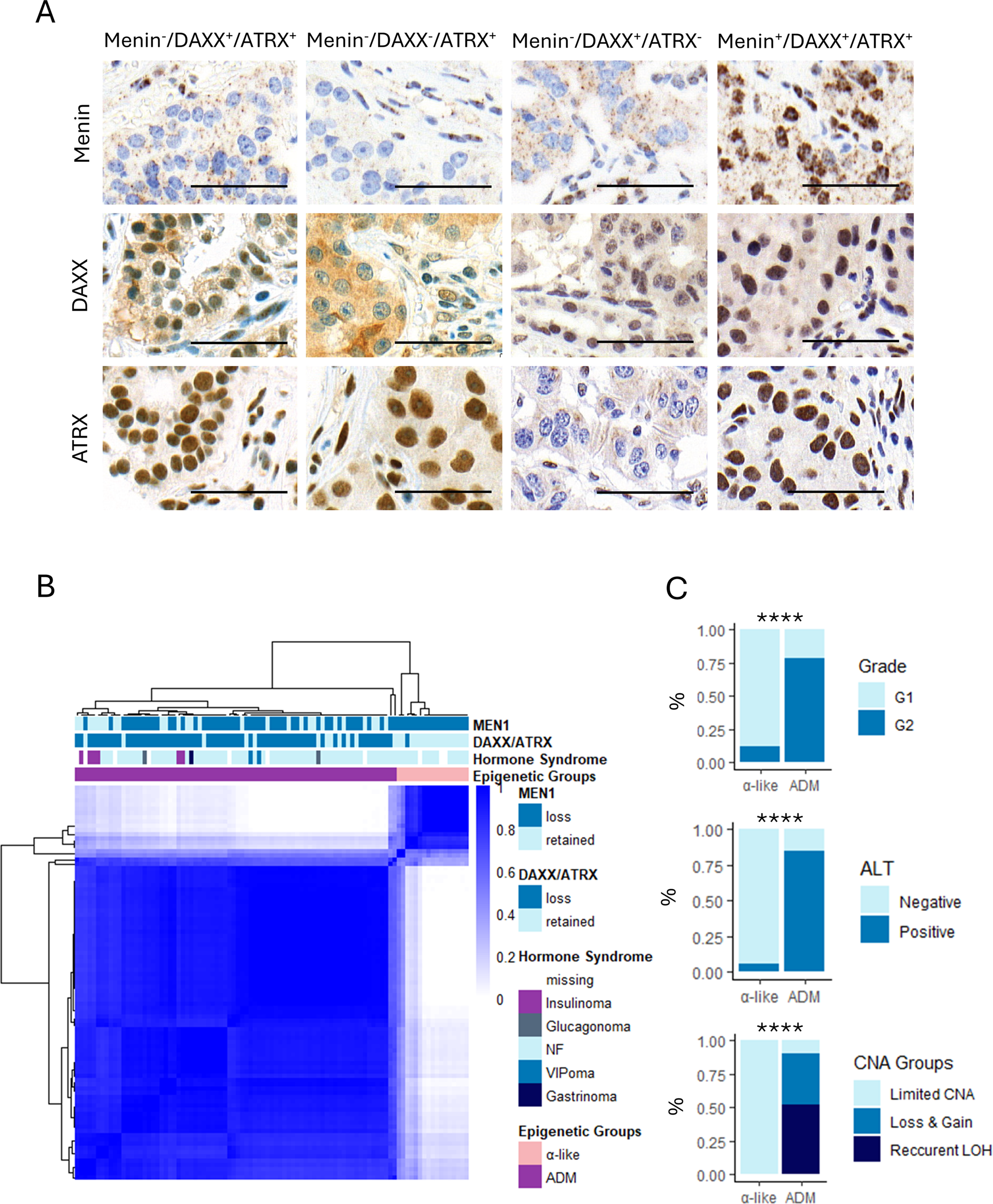 Molecular Subtypes of Pancreatic Neuroendocrine Tumors Mutated in  Explain Biological Variability