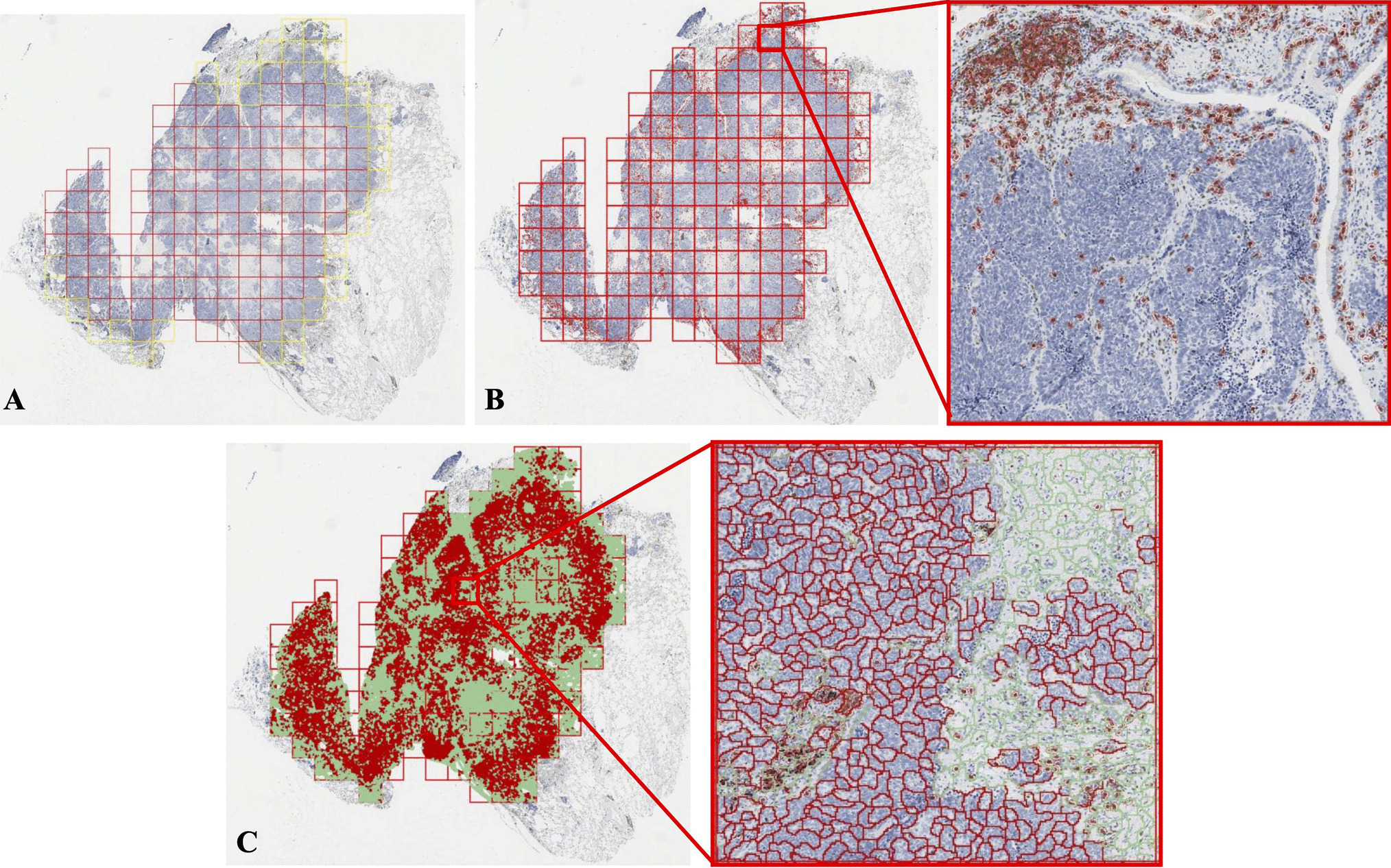 Digital Immunophenotyping of Lung Atypical Carcinoids and Large Cell Neuroendocrine Carcinomas Identifies Three Subtypes With Specific Tumor-Immune Microenvironment Features