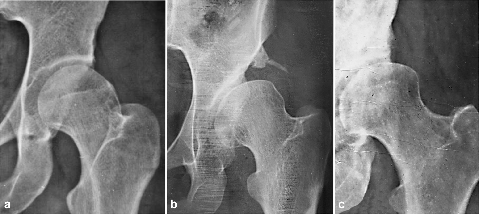 Hip shelf arthroplasty for acetabular dysplasia in adolescents and adults long-term results