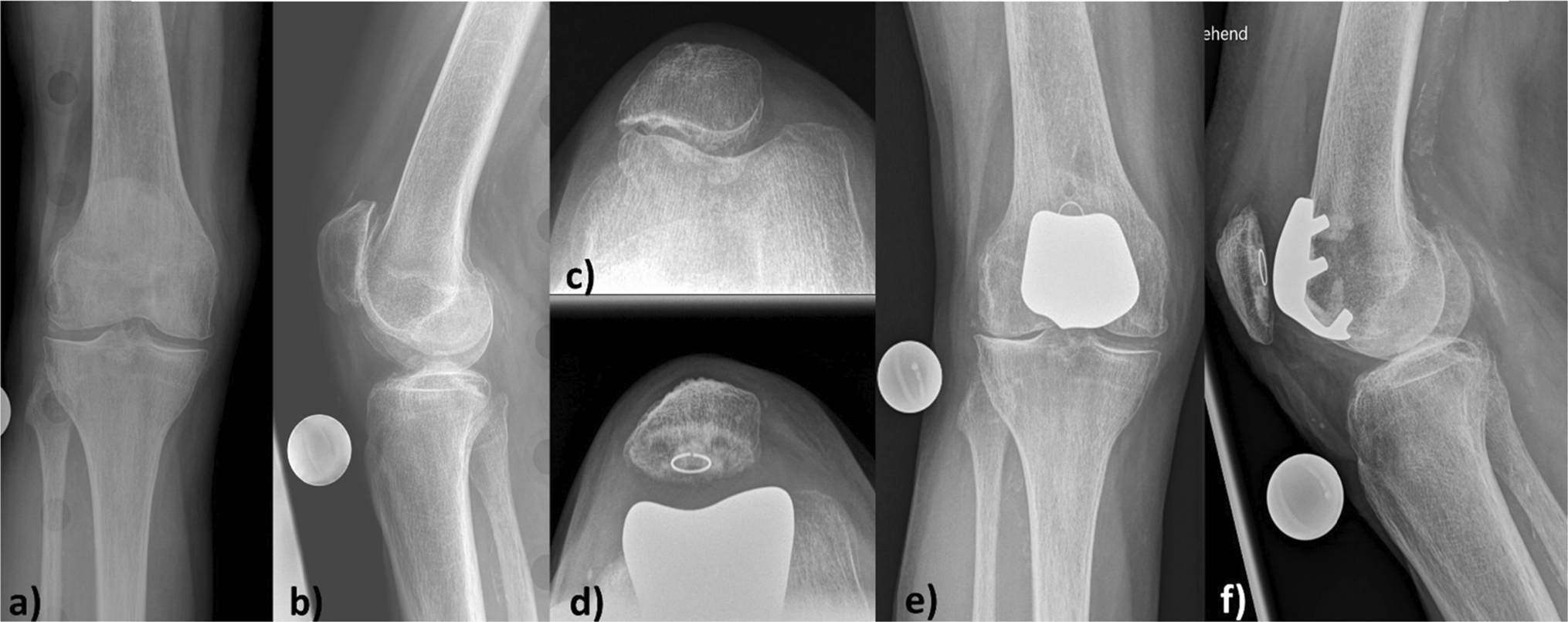 A two to fifteen year follow-up case series of ninety one patients after onlay patellofemoral arthroplasty highlighting the impact of preoperative symptoms and mental health
