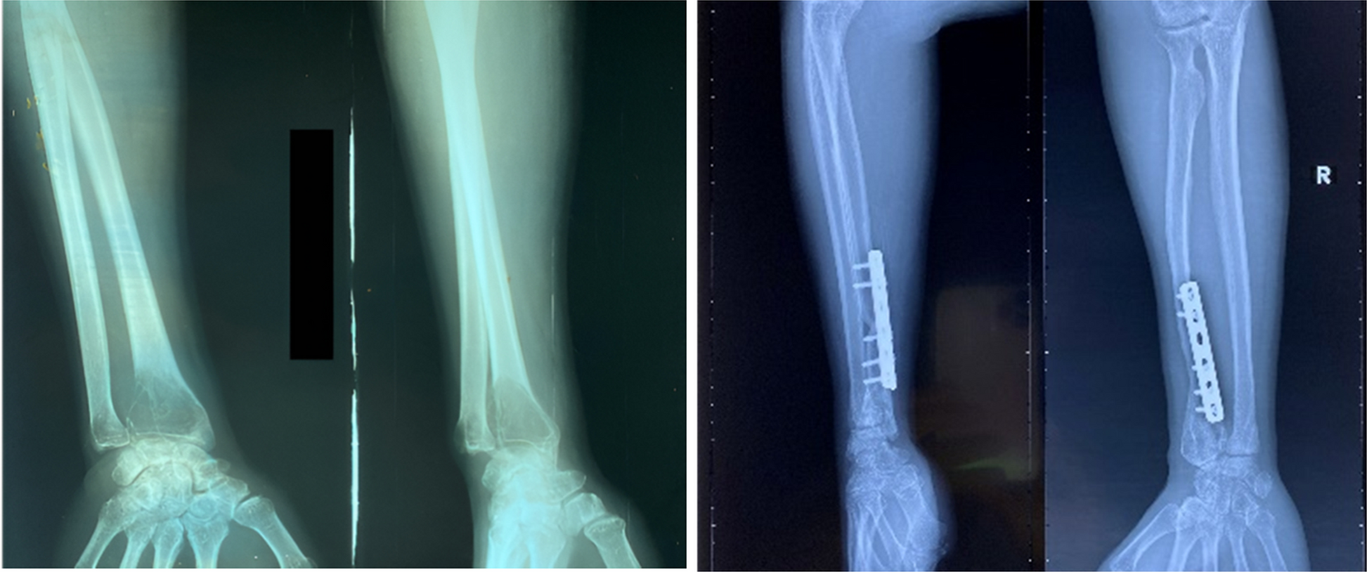 Management of distal radius giant cell tumours using En-bloc resection, non-vascularized ipsilateral fibular head–shaft autograft, and distal radioulnar ligament reconstruction