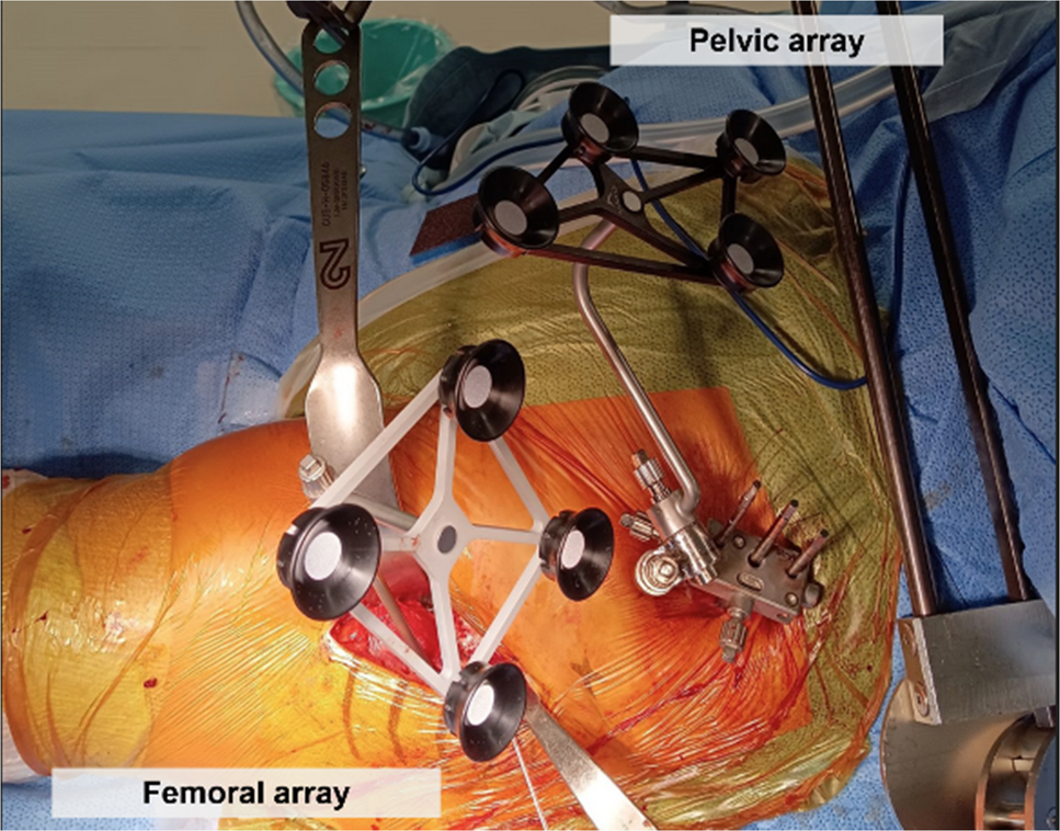 Accuracy of intraoperative leg length and stem version measurements in robotic-assisted total hip arthroplasty using the Mako system with enhanced mode