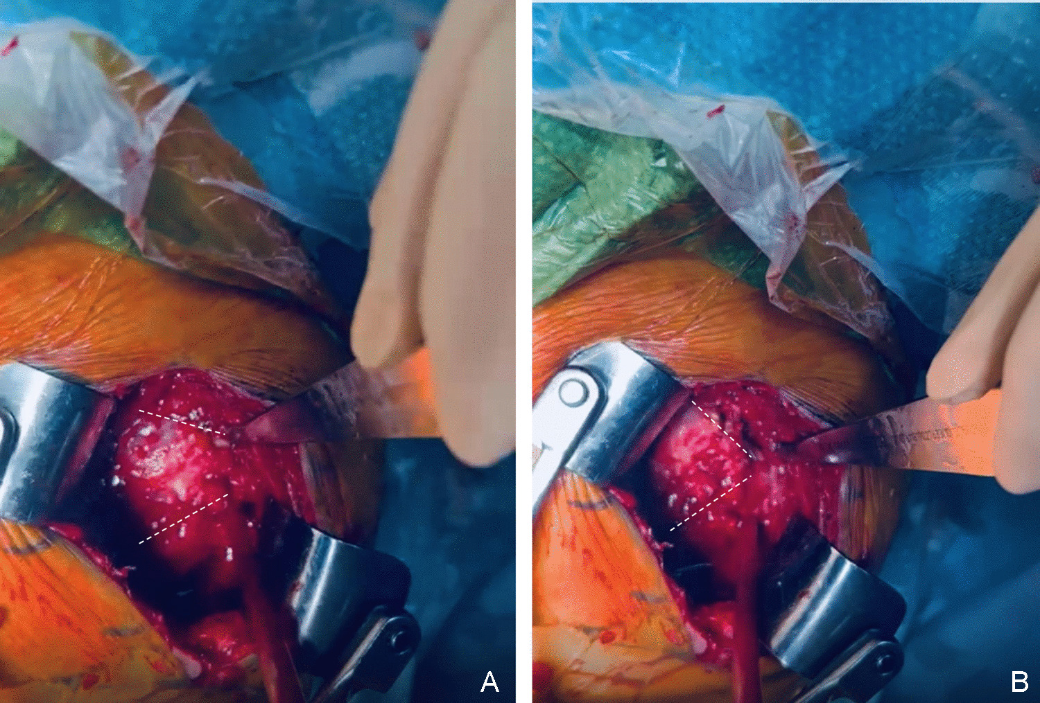 Response to correspondence: Commentary on Muscle-Sparing approaches in reverse shoulder arthroplasty
