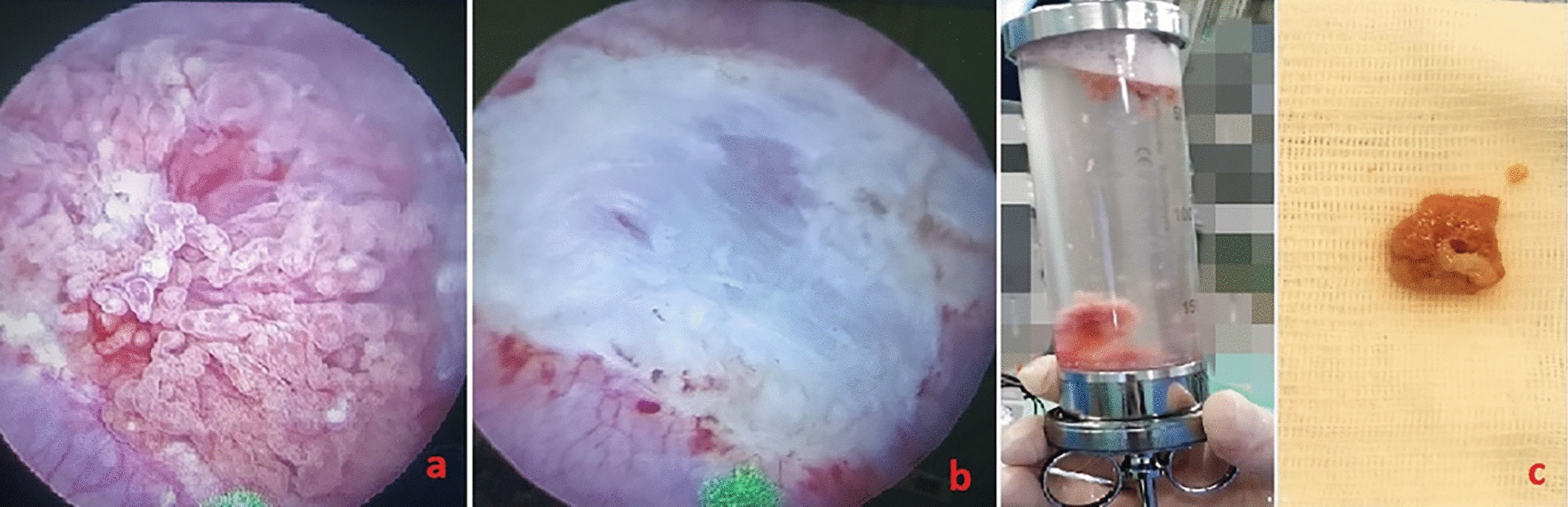 Holmium laser en‑bloc vs bipolar and conventional monopolar TURBT for non‑muscle‑ınvasive bladder cancer
