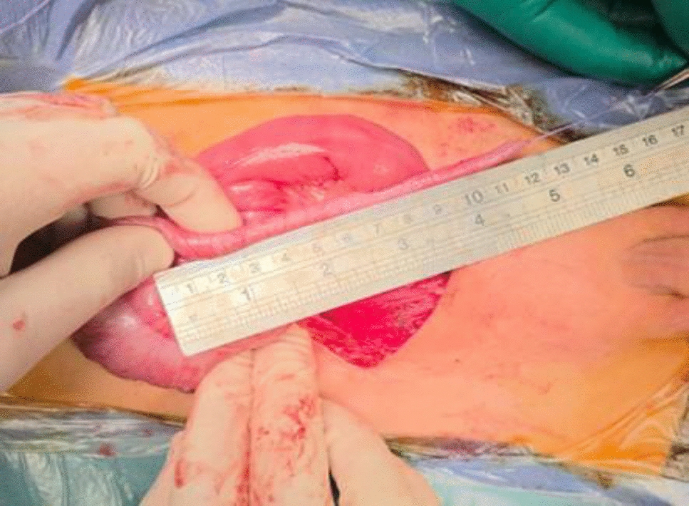 Early outcomes of concurrent MACE and Mitrofanoff procedures for management of neuropathic fecal and urinary incontinence in children. Al-Azhar experience