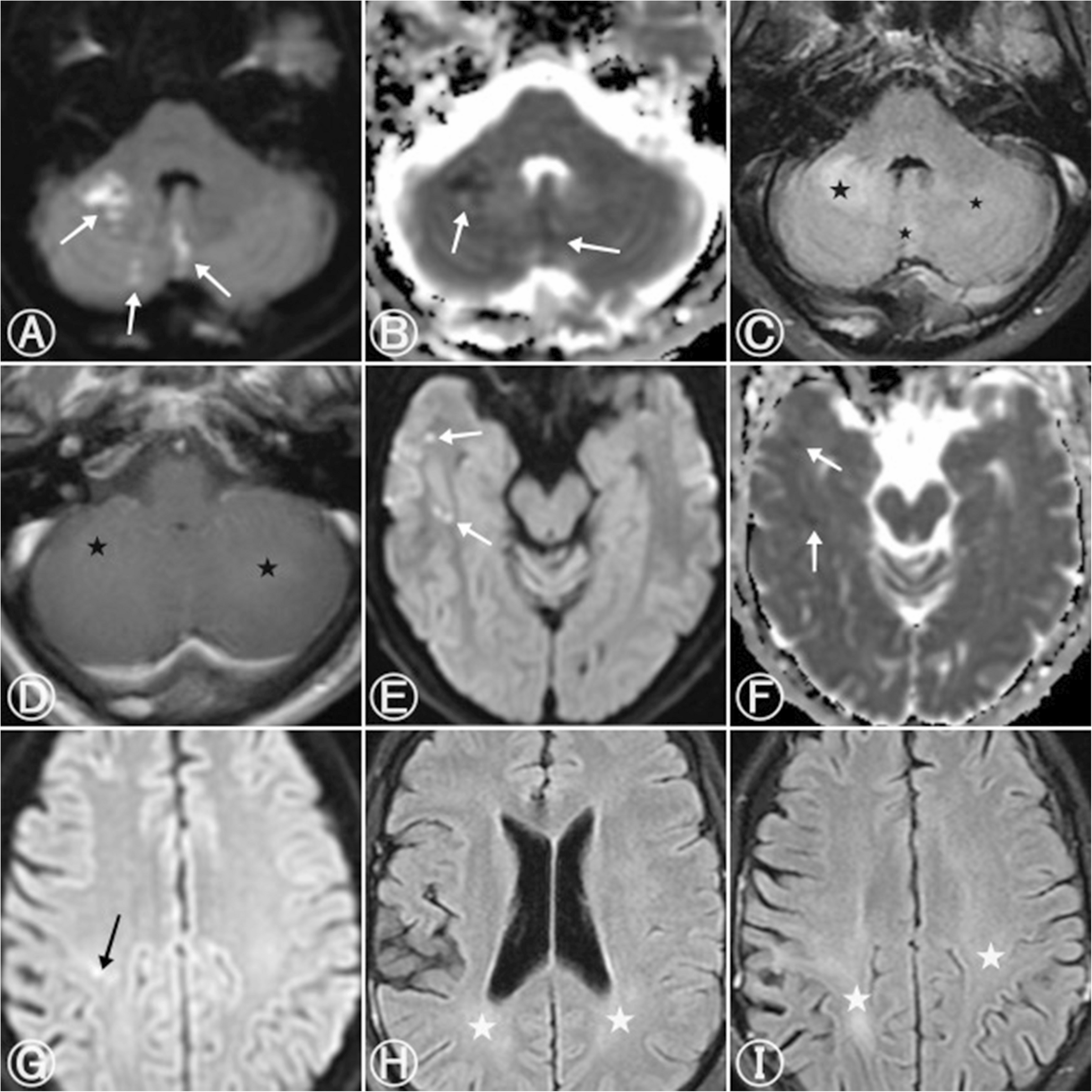 A Rare Case of Anti-Yo Positive Paraneoplastic Limbic Encephalitis Associated with Thyroid–Parathyroid Adenoma