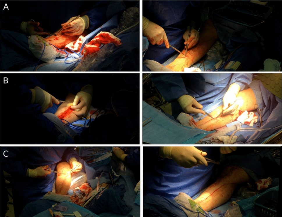 Enhancing open-surgery gesture recognition using 3D pose estimation