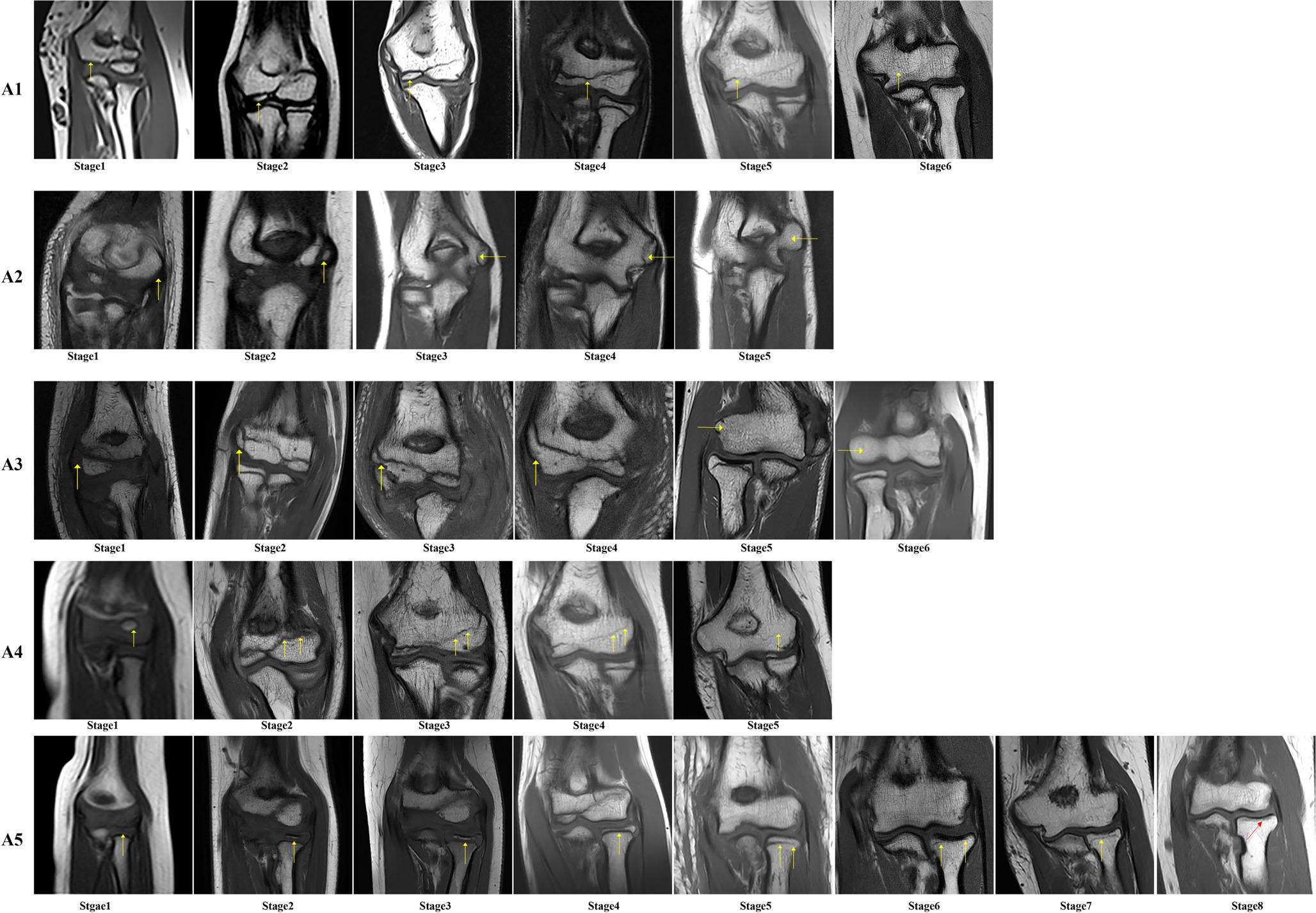 Forensic age estimation and legal age thresholds classification based on the elbow MRI and data mining in a Chinese population