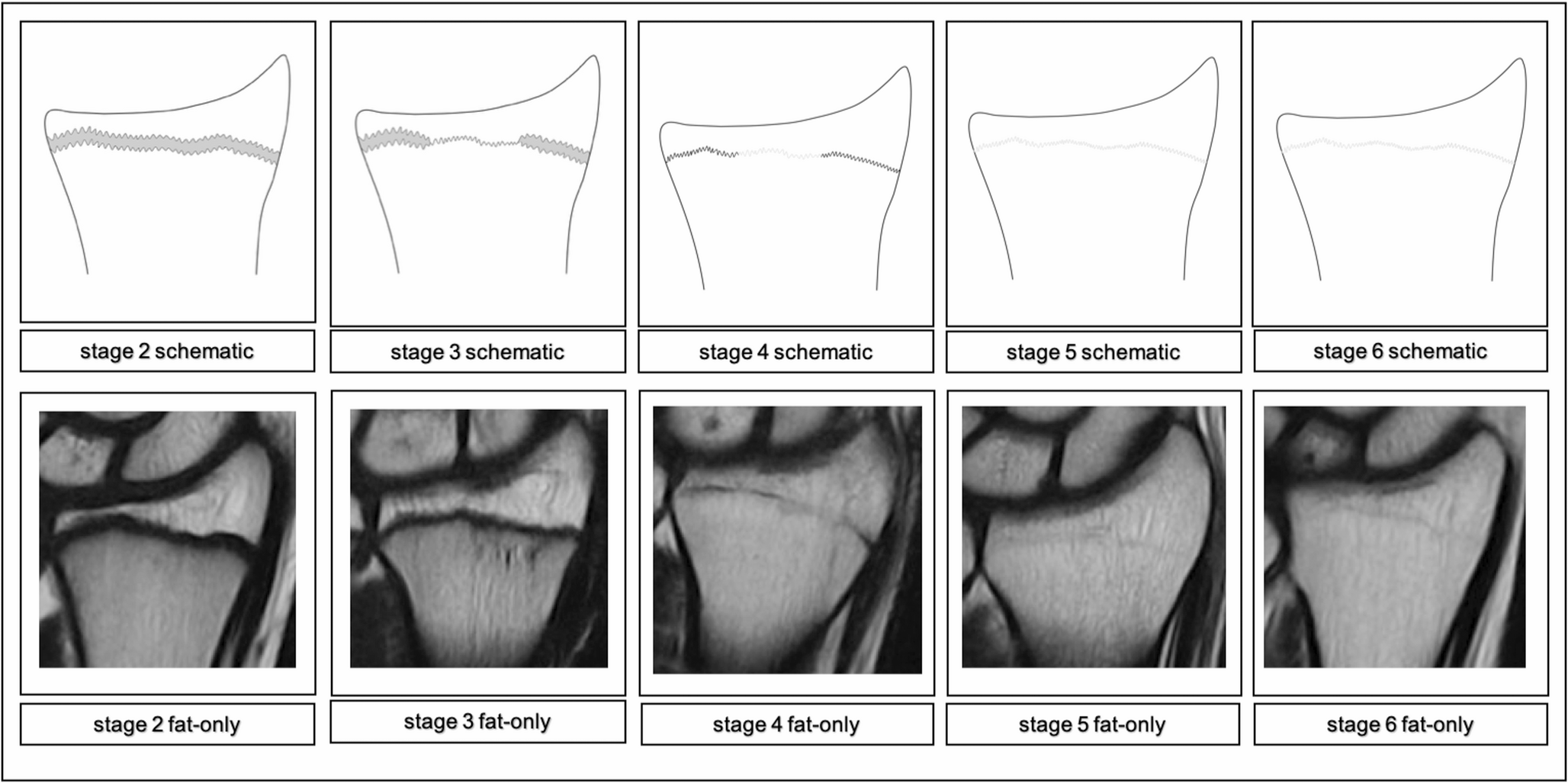 Forensic age estimation in the living by 0.31 Tesla low-field MRI of the distal radius
