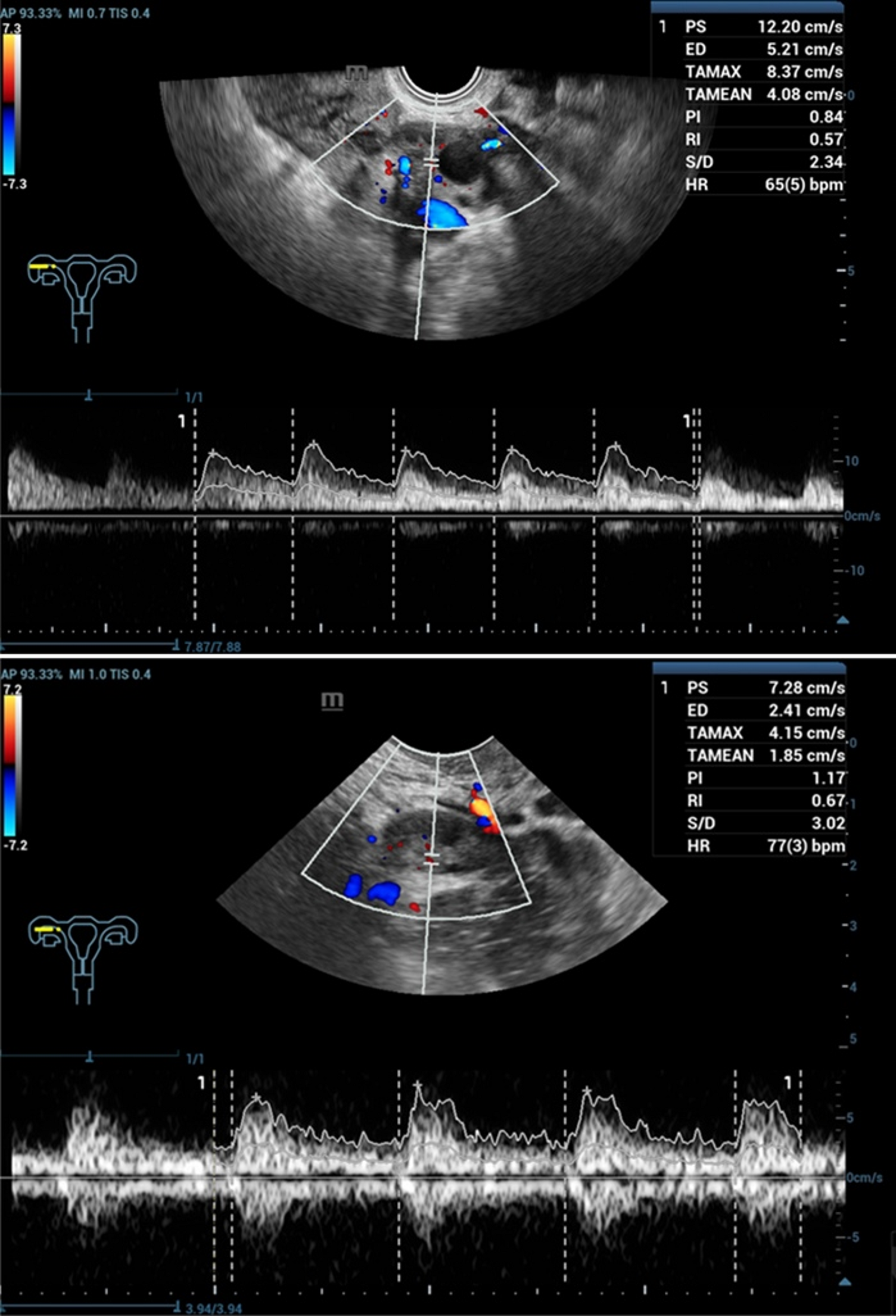 Multimodal ultrasound assessment of ovarian reserve