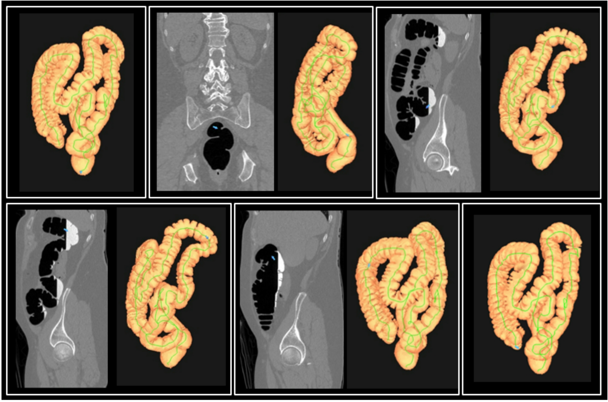 CT colonography for longitudinal in-vivo assessment of colonic lengthening in middle-age and older adults