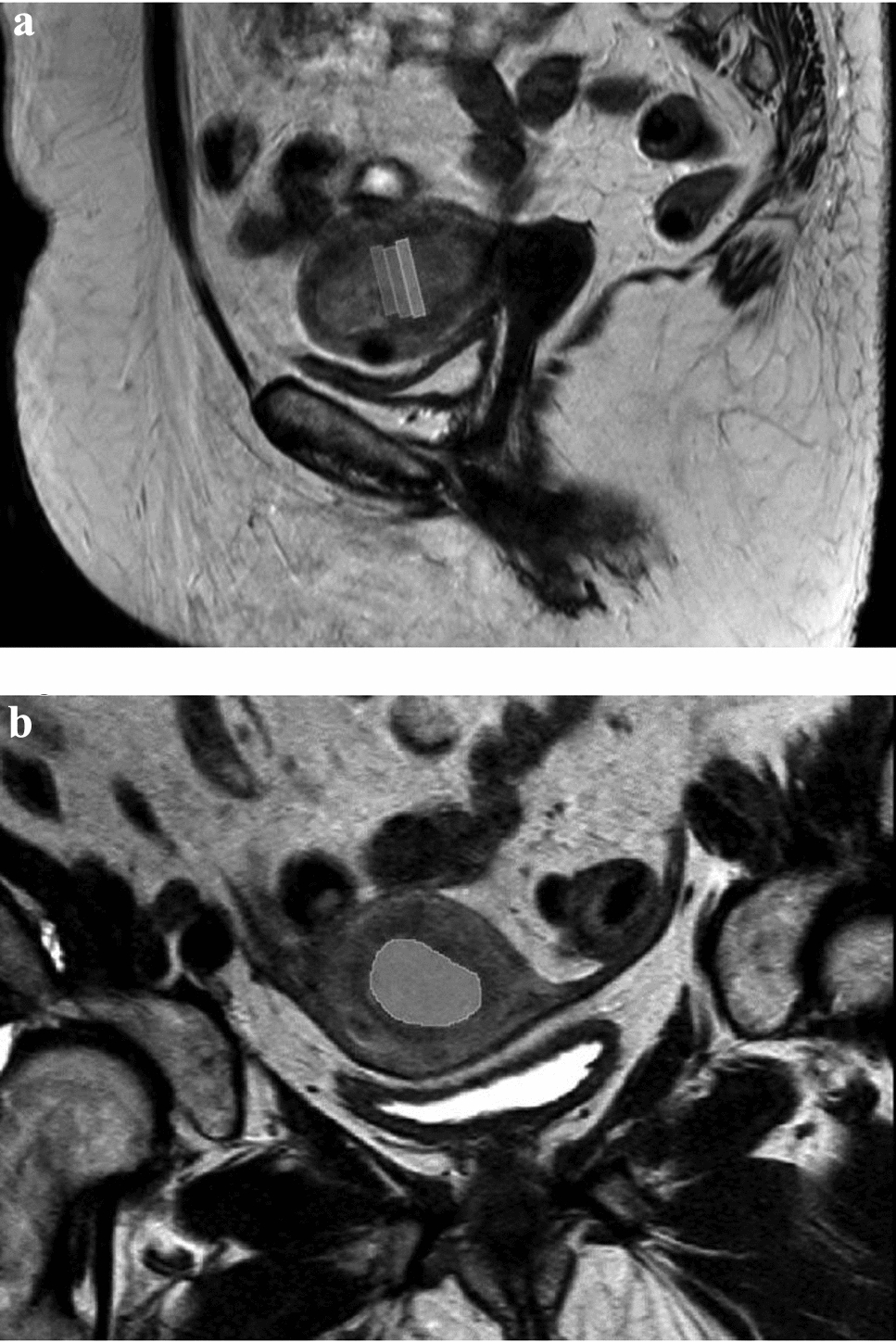 Preoperative risk assessment of endometrial cancer using histogram analysis of weighted and quantitative MRI images