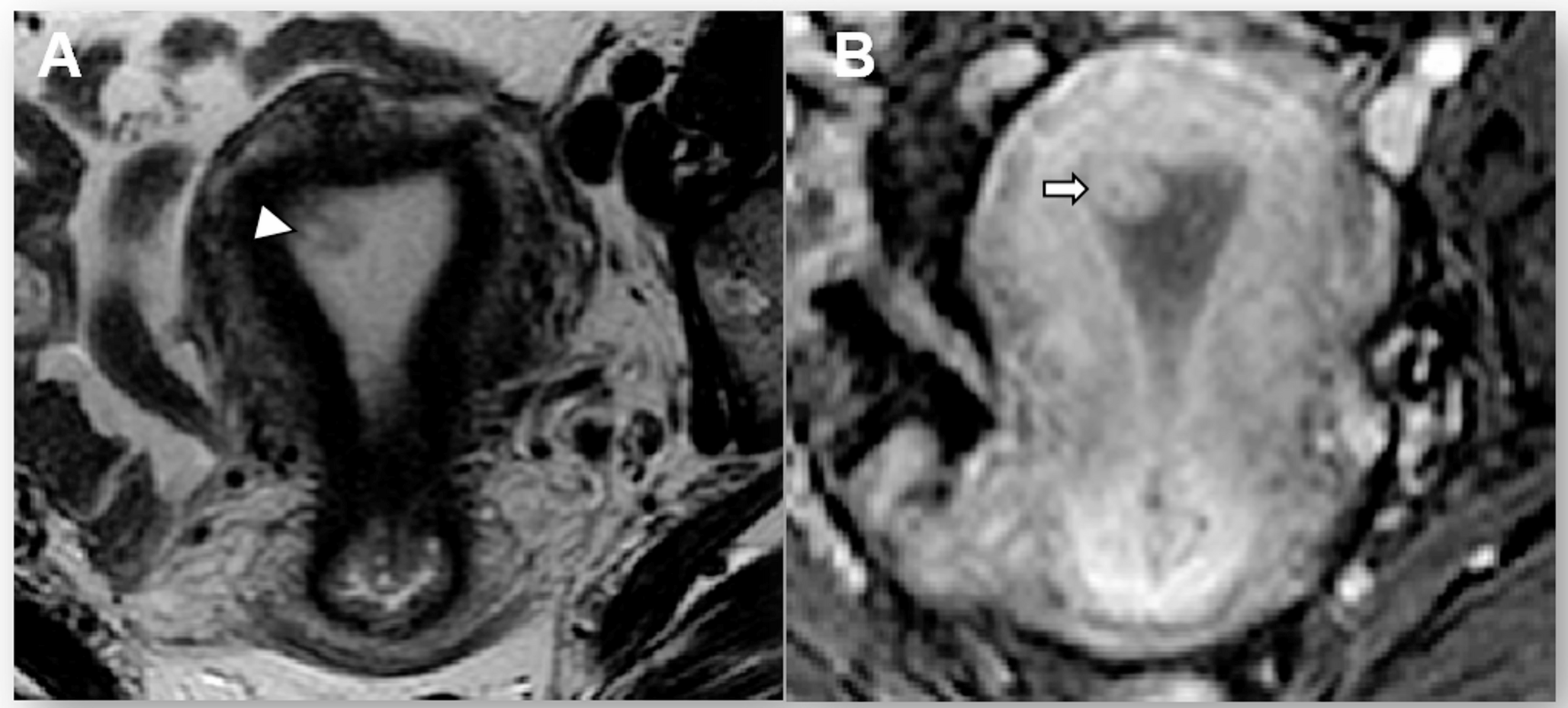 The updated 2023 staging of endometrial cancer: tips for MRI interpretation