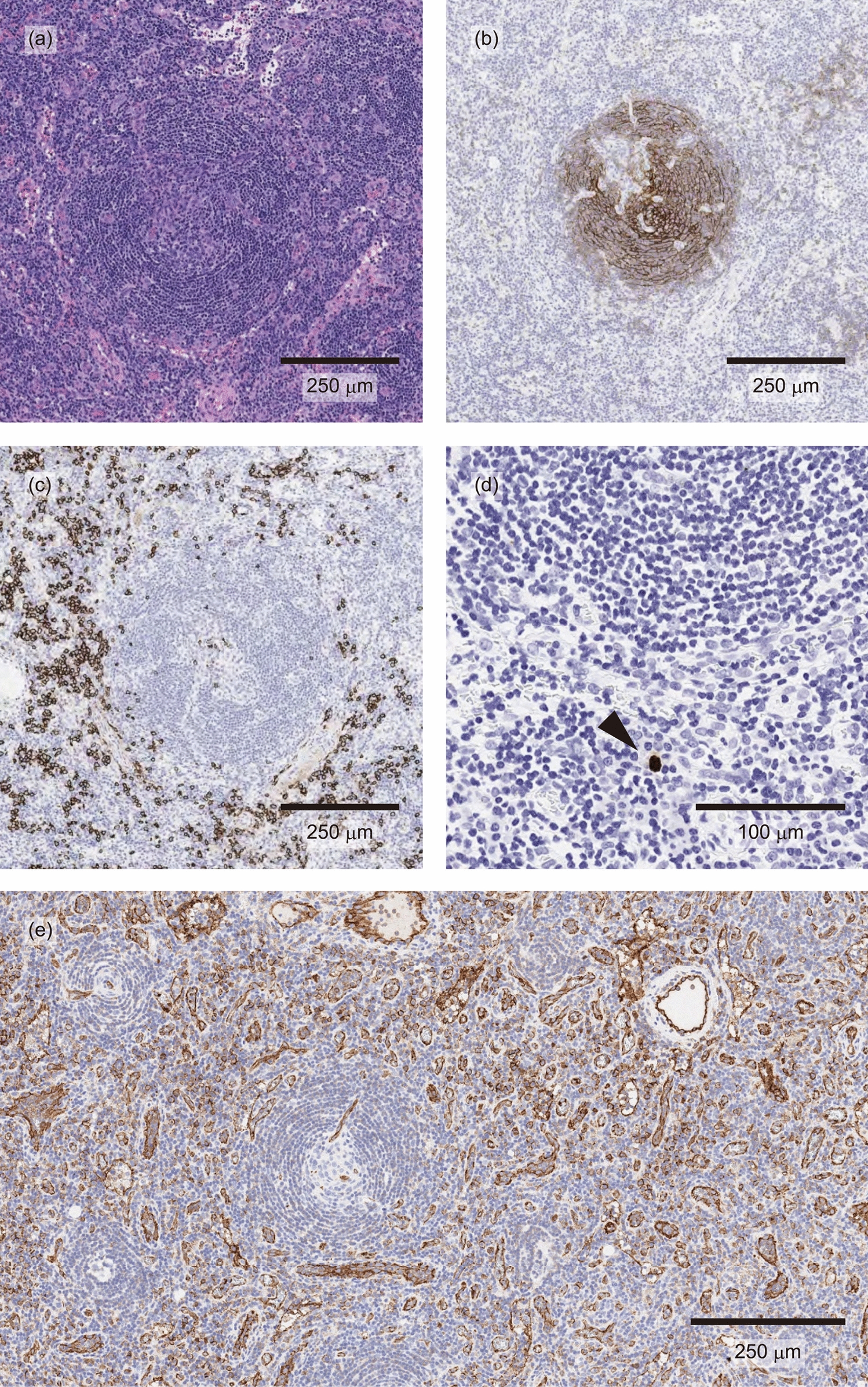 Ruxolitinib in relapsed/refractory TAFRO syndrome: a report of two cases, including one positive for Epstein–Barr virus, and a literature review